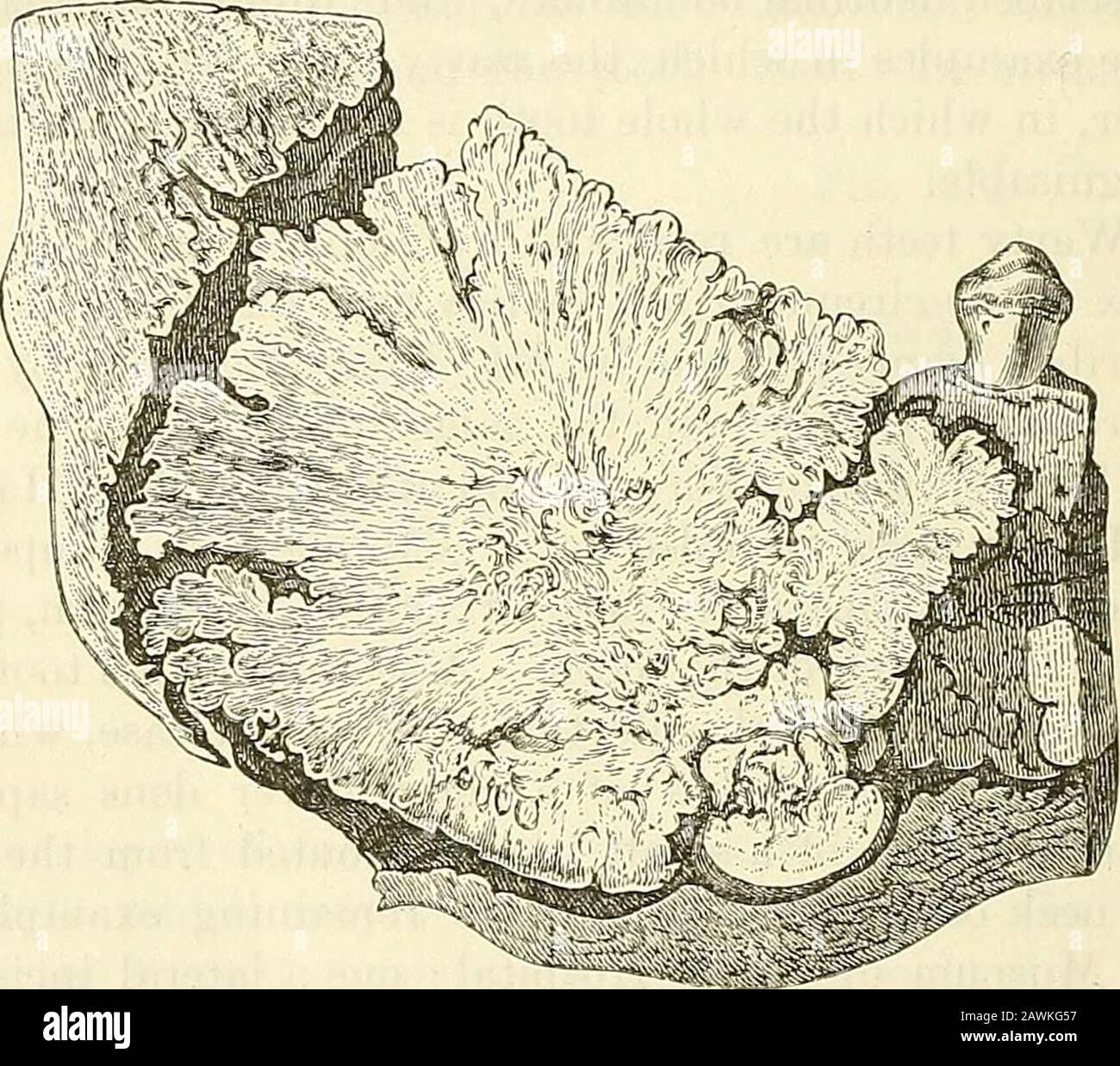 Un sistema di chirurgia : teorico e pratico . lato sinistro della mascella inferiore. Esso rappresentava due denti molari con i loro tessuti arrossidether in totale confusione e in una massa shapeless. Sotto di esso si formava un terzo tollerabbliwell molare. La mascella cominciò ad espandersi nella prima infanzia, e continuò a farlo fino a quando il paziente raggiunse l'età di venti anni, quando M. Dimentica rimosso l'angolo della mascella, incluso il tumore. La massa è stata ricoperta di gomma, ad eccezione di uno spazio sulla sua superficie della dimensione di una sixpence. C'era un certo dolore a volte: Le ghiandole submascellari sono state ingrandite, andparecchi pus fistidous Foto Stock