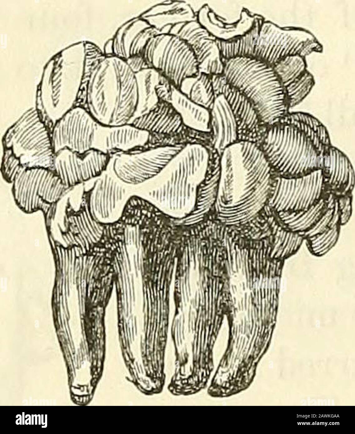Un sistema di chirurgia: Teorico e pratico. Due denti premolari su entrambi i lati della mandibola. Il theright è stato rimosso piuttosto facilmente dai denti-strumenti, ma il paziente ha rifiutato di avere theother interfered con. Nel caso Wedls l'intero secondo dente molare inferiore del lato destro è stato sviluppato come una grande massa complicata in cui i vari tessuti dei denti erano confondenti. Era soprastante e mantenente giù il saggezza-dente. Con una coppia di forcipe itè stato rimosso senza molta difficoltà. Il campione descritto dal Sig. Tomes è esattamente lo stesso di quanto sopra. È costituito da un co Foto Stock