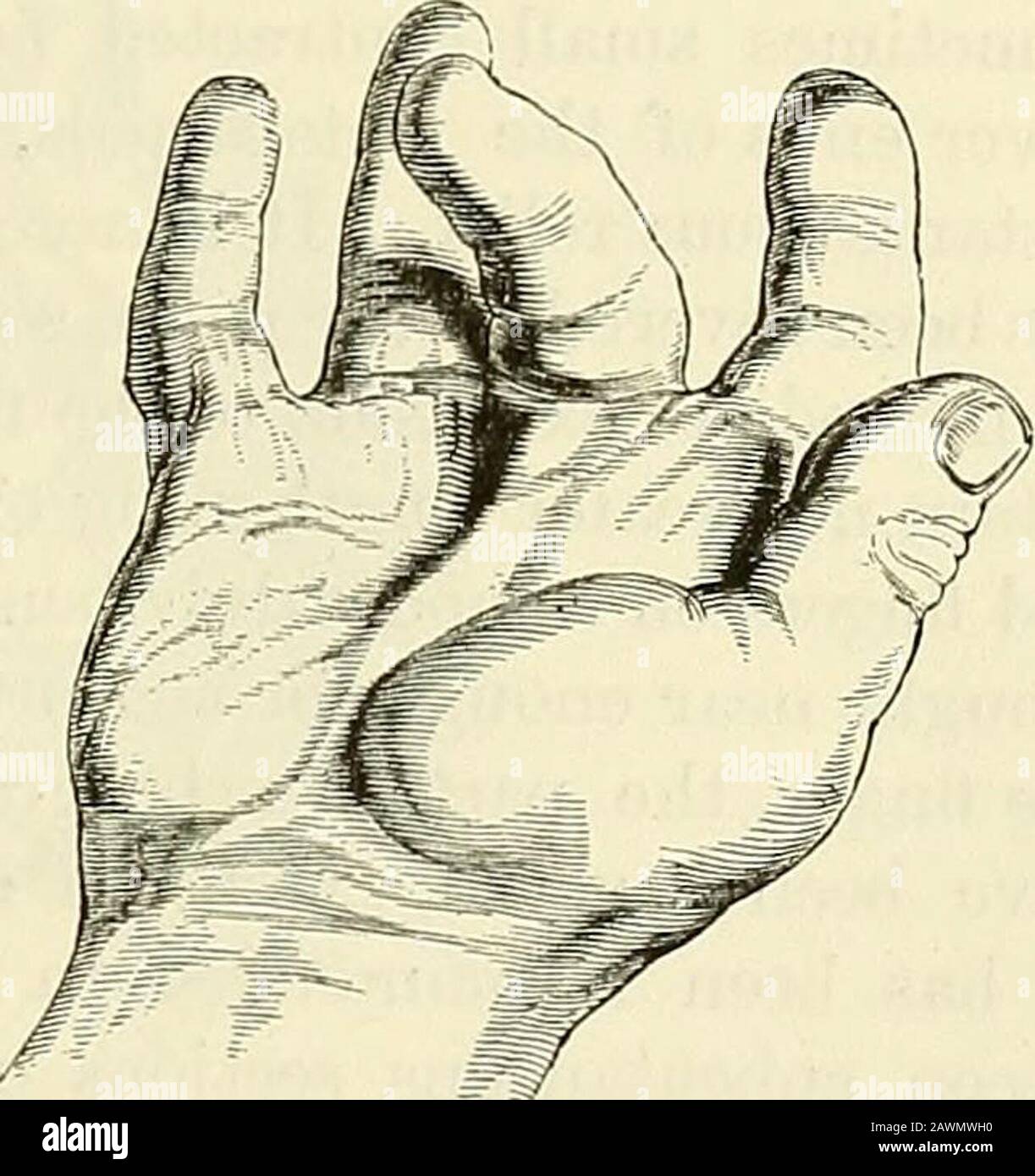 Un sistema di chirurgia : teorico e pratico . estensori allali inattivi, e becamegraduamente affetti da accorciamento secondario. La mano normale, posta il più vicino possibile nella forma di una di queste mani molto con-ted, così quasi assomiglia ad essa, tranne per quanto riguarda l'assenza di contrazioni distinte di tessuti, Che è difficile non beKeve che la pelle ha tanto da fare con le sporgenze e le solchi prominenti come la fascia e che sono entrambi gettato intofolds da azione muscolare; Infatti, quel muscolo e tendine nervosi sono l'agentsin primaria la contrazione, e non la fascia, come Dup Foto Stock