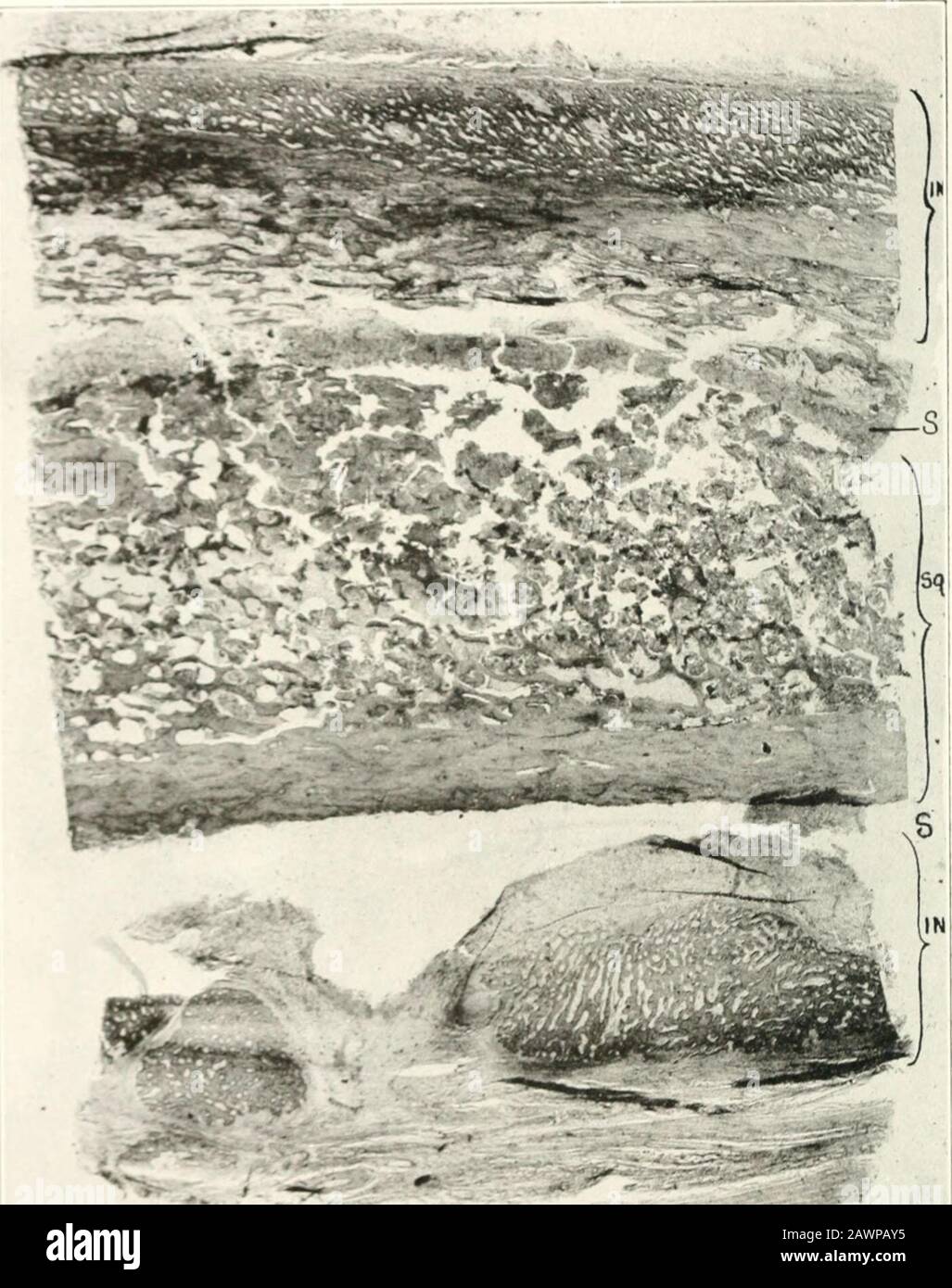 Studi dei laboratori del Dipartimento di Chirurgia . Fig  12.-sezione trasversale del grande seqnestrum e.xtcnilini; lunghezza quasi intera dell'albero; SQ, sequestrum: /». Invohicrum; zona di separazione .S. Il tipo B. questo presuppone che a seguito di lesione wandcrinjj; cellule di tessuto connettiveato, fibroblasti, sono tirate nell'area di trauma. A causa dello stimolo della riparazione, le tliey vengono trasformate in ossa i)rodutina,&lt;j:cellule e poi diventano cellule sjecifiche. 3. La deposizione extracellulare della teoria dei sali di calcio presuppone che non vi sia alcuna cellula i)ro(cellula lucente; tliat followin&lt;,r lesione, Foto Stock