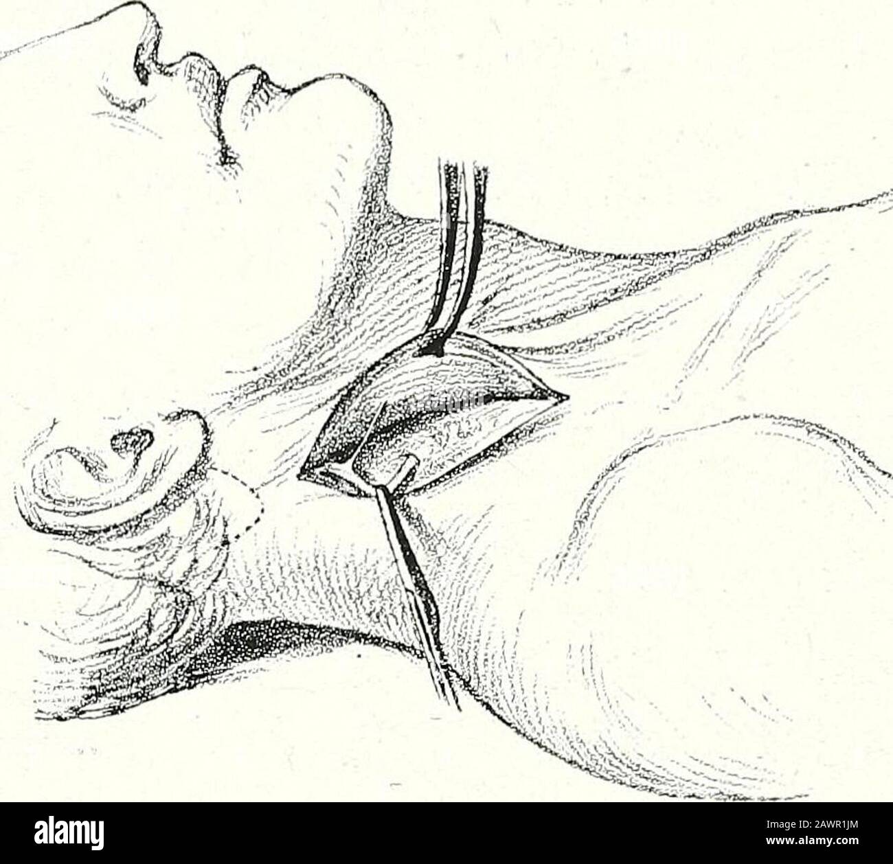 Terapie chirurgiche e tecniche operative . Torticollo. Il torticoUis spasmodico doloroso è un affetto abbastanza doloroso quanto il dou-loureux TIC del viso, con l'inconveniente superaggiunto di quasi completamente eimpossibilità di mangiare o bere senza avere la testa saldamente tenuta da un assistente, o con un apparato appropriato. Per la cura dello spasmodictorticollis, sono state suggerite operazioni sul nervo accessorio spinale, nervo suboccipitale, o rami posteriori del plesso cervicale; alsosezione dei muscoli contratti. Tali interventi che coinvolgono i thenerves sono necessariamente produttivi o Foto Stock