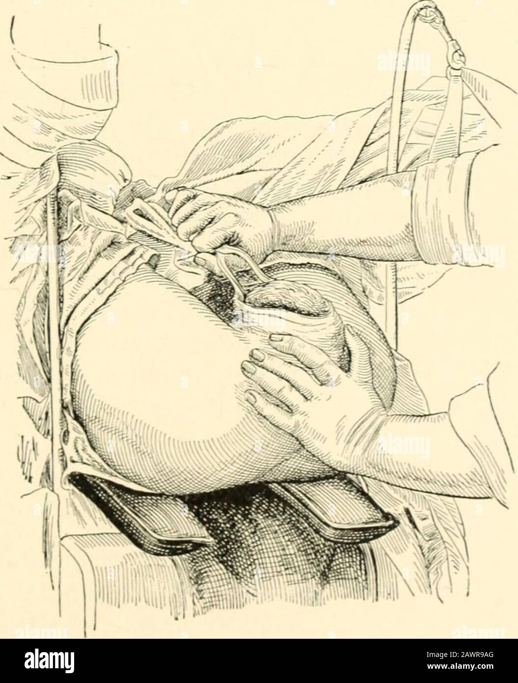 Un libro di testo di ostetricia . ; 1 Fig. 535.-estrazione della testa dall'orifizio vulvar: Terzo stadio.. I , 536.- estrazione della testa dall'orifizio vulvar : quarto stadio. 74- OBSTE TRIT OPERA TIO.XS. Nella descrizione dell'applicazione delle pinze si è supposto che la testa si trovi in una normale posizione obliqua di presentazione avertex e che le lame (^ lo strumento sia applicato ai lati n della testa fetale, dove dn il danno, e al contorno del quale è stata regolata la curva cefalica. Accade spesso, tuttavia, che la testa rnti-pies una pos anormale Foto Stock