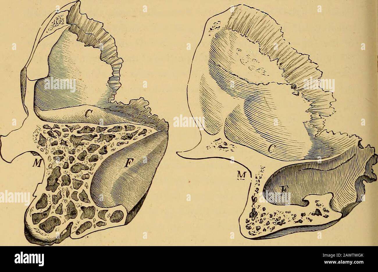 Le malattie dell'orecchio ed il loro trattamento. Nervo ngeal alimenta principalmente l'orecchio medio con le fibre sensoriali. Il suo piccolo ramo, il timpano o il nervo giacobson, entra attraverso il pavimento della cavità timpanica, allungando un solco, spesso in parte a ponte sul promontorio, e poi si distribuisce sulla mucosa del tym-panum. Questo nervo è collegato da una parte con l'oticganglio del trigemino dal piccolo nervo petrosale superficiale, che si estende sotto il canale del muscolo tensore timpani, e dall'altra parte con il simpatico da piccoli ramoscelli da teint Foto Stock
