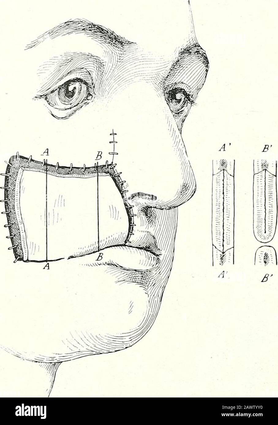 Terapia chirurgica e tecnica operativa la perdita di sottostazionee la sua superficie grezza (Fig. 188). Seconda fase.- La Cubatura della ferita, la vivificazione del suo margine, e la sutura del margine del lembo brachiale a tre quarti della peripodella ferita. Terza fase. - applicazione di vestirsi e di bendaggio immobile. 96 TRATTAMENTI CHIRURGICI E TECNICA OPERATIVA Secondo e Terzo Intervento. La seconda e la terza interventionsono condotte come sopra descritto per la ricostituzione della parete interna del chee4&lt;:. Fig. 189 rappresenta la chiusura della fase finale delterzo inter Foto Stock