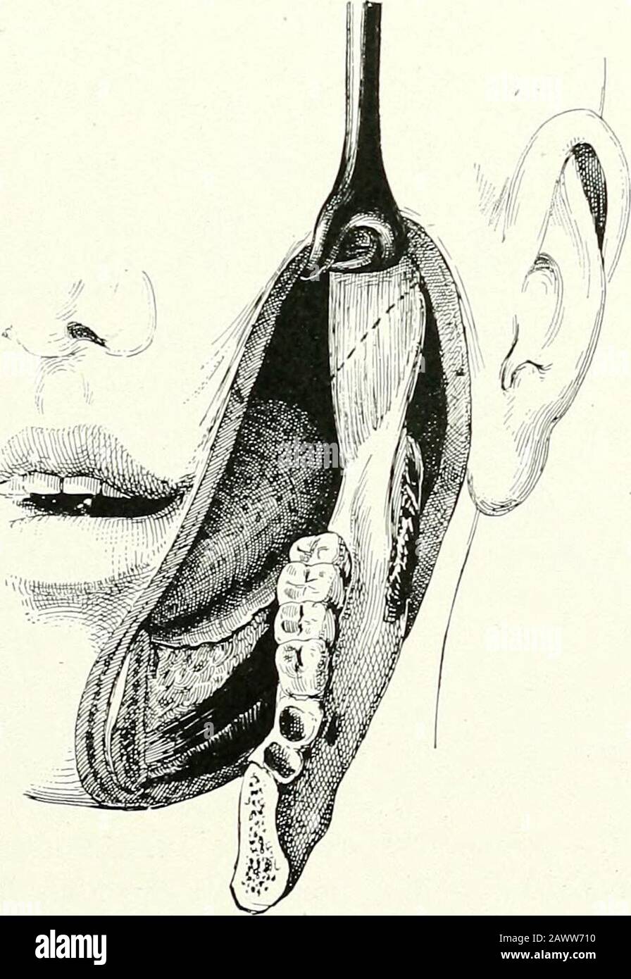 Terapie chirurgiche e tecniche operative . Fig. 178.- Resezione Unilaterale Della Mascella Inferiore. L'osso, diviso al centro, è ormai quasi staccato. Si osserva il tendine del muscolo temporale. Fig 17!». - Resezione unilaterale Di Maxilla.Same Fase di funzionamento Inferiore vista dalla parte anteriore. Foto Stock