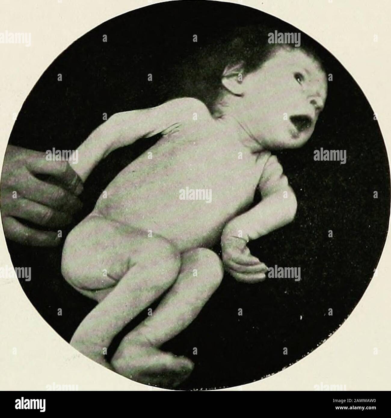 Le malattie mediche dei bambini possono essere ottenute dalla separazione. Fig. 40.- Epifite Sifilitica: Ondine sopra entrambi i gomiti ascun polso sinistro. Epifisi. Le braccia sono più comunemente colpite rispetto alle gambe. Le lesioni possono essere posizionate simmetricamente o meno. CEdema delle mani e dei piedi si sviluppa occasionalmente con epifisite sifilitica. La diagnosi non è difficile. Se è presente gonfiore, il caso può essere confuso con lo scorbuto infantile; se assente, la poliomielite acuta può essere sospettata. In entrambi i casi, l'incidenza dell'età della malattia deve rendere chiara la diagnosi. Lo scorbuto è sconosciuto prima del f Foto Stock