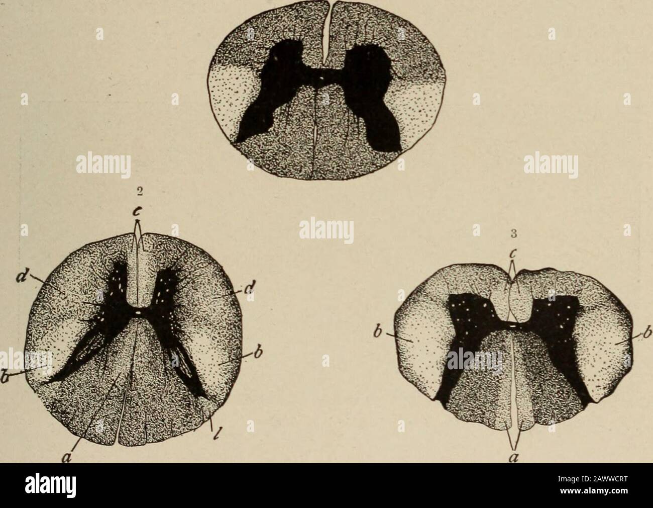Malattie nervose e mentali. Le ssioni dei cornui anteriori sono generalmente più pronunciate al di sopra della regione dorsale, ma il coinvolgimento dei tratti piramidali incrociati si estende ai livelli del lotestcord. Cambiamenti simili possono essere tracciati attraverso il midollo, assottigliando la materia grigia sotto il quarto ventricolo e nei tratti piramidalici sopra le decussazioni. Questi ultimi possono montare attraverso i peduncoli e le capsule interne agli strati di cellule piramidali della corteccia, e là una degenerazione cellulare, identica a quella nel grigio spinale, può occasionalmente essere incontrata. I muscoli sono pallidi e grassi, un Foto Stock
