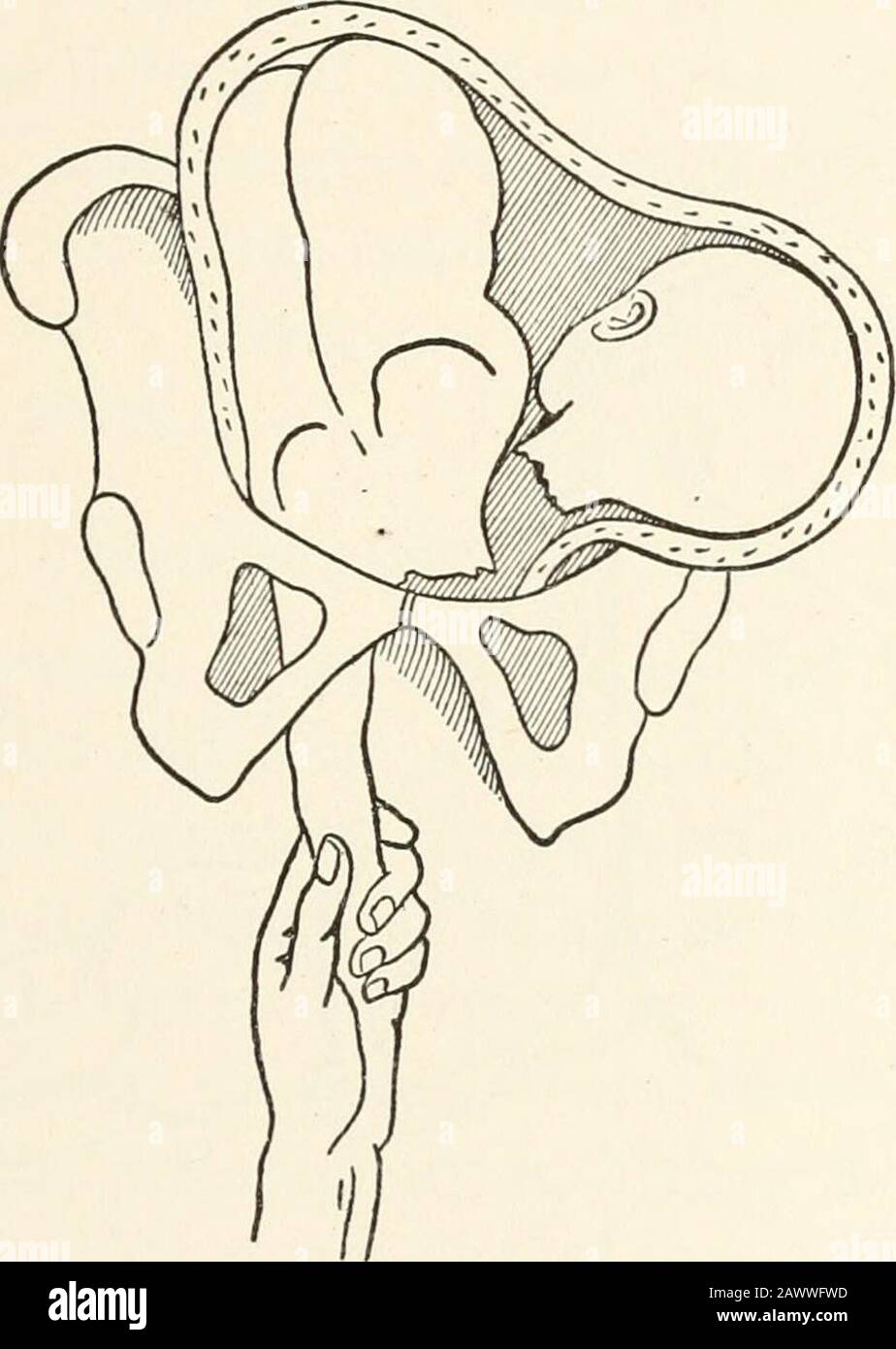 Un testo-libro di ostetricia pratica, comprendente gravidanza, lavoro, e lo stato puerpico, e chirurgia ostetrica. EMBRIOTOMIA CD. 159 sul gancio viene quindi effettuata una forte trazione per assicurare una presa salda sul collo, le dita rimanendo in posizione soas per certificare che il punto del gancio non ferisce parti quaternari. Il gancio viene fatto ruotare, la trazione essendo manutenzionefino a quando il collo non si sente cedere attraverso la rottura della colonna del perno. Come regola generale, anche le parti morbide vengono così separate, e il gancio viene rimosso lungo le dita. Se il gancio non riesce a cucire completamente l'attaccapm muscolare Foto Stock