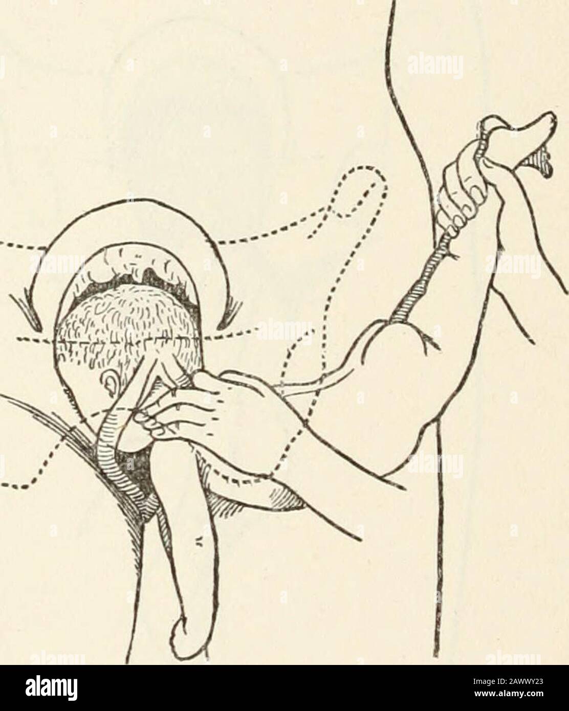 Un testo-libro di ostetricia pratica, comprendente gravidanza, lavoro, e lo stato puerpico, e chirurgia ostetrica. Sia portato direttamente verso l'alto (Fig. 56). In casi favorevoli, la faccia, la broccia e la testa si muoveranno sul perineo e l'estrazioni saranno complete. Un'estrazione così facile come questa è l'eccezione, tuttavia, dal fatto stesso che quei casi che demandversion presuppongono solitamente una sproporzione tra la dimensione della testa e del canale pelvico. In tal caso, sono necessarie altre 114 OPERAZIONI DI OSTETRICIA. L'operatore, come nel metodo precedente, consente al corpo dei bambini r Foto Stock