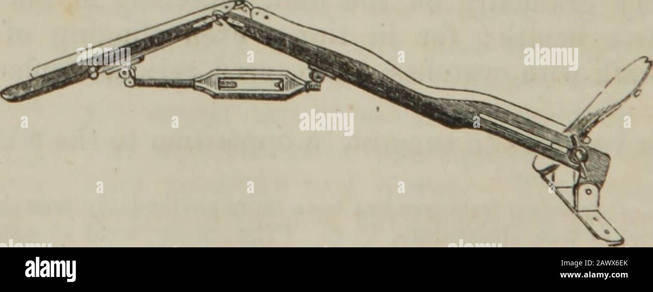 La pratica della chirurgia. Frammento pper è tiltedmuch avanti, per l'azione dei muscoli psoas e iliacus, mentre, dai muscoli della coscia, il frammento inferiore è tirato verso l'alto, andsolitamente verso l'interno, l'azione degli adduttori preponderante. La deformità e l'accorciamento con-sequent sono grandi. Sono molto evidenti l'estensione e la rotazionedocità distinte del crepito, e la mobilità pre-ternaturale della parte, con perdita di continuità nell'albero. La regolazione è stata effettuata, per estensione e coaptazione, l'arto può essere fissato alla lunga stecca diritta; e talvolta è conveniente, in aggiunta, Foto Stock