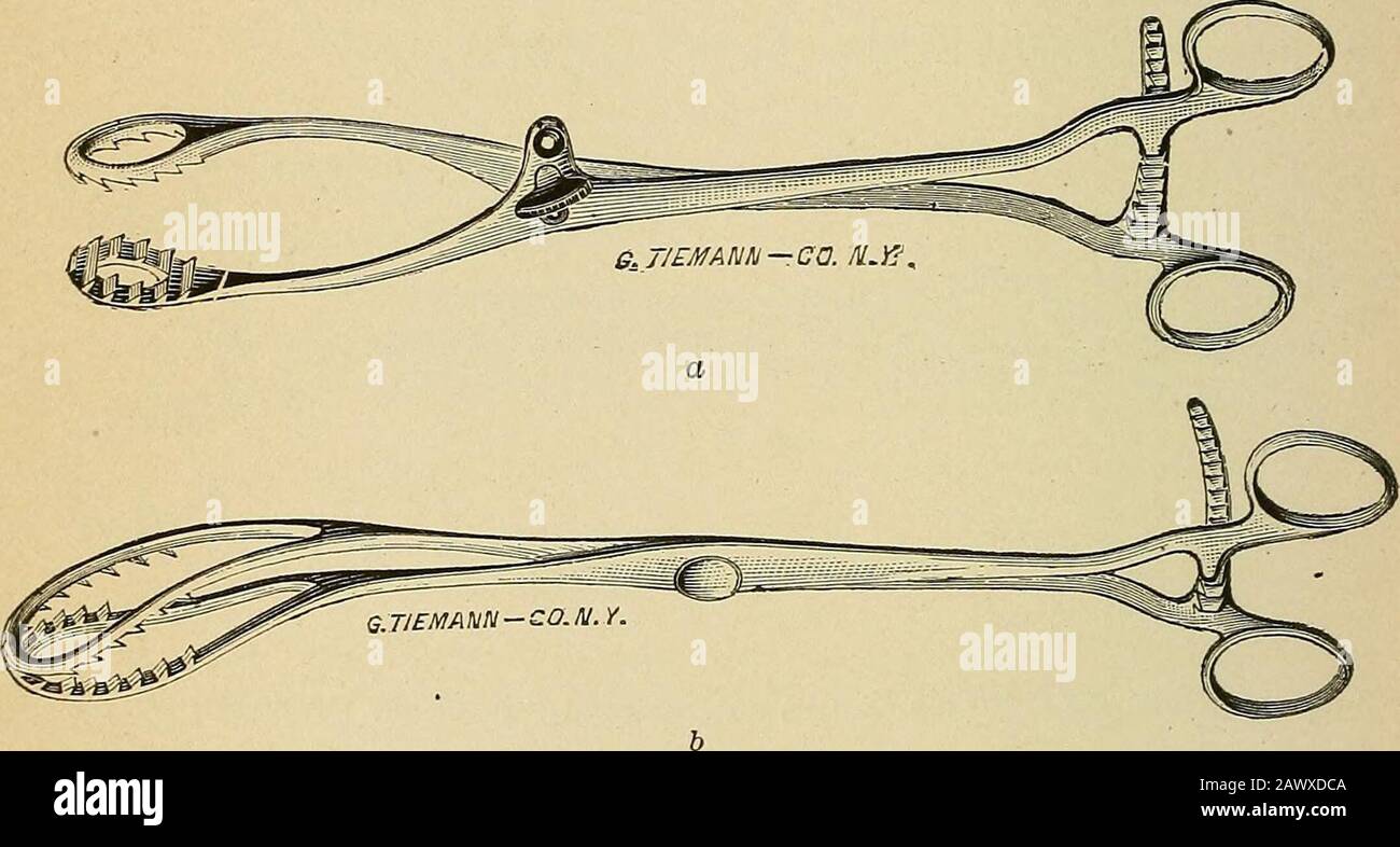 Trattato su gynæcology : medico e chirurgico . o attaccare thetumor alla fourchette e fare le nostre incisioni a quel livello, come ad-trasmesso da Dupuytren.33 Quando il volume del tumore è stato suf-ficiently diminuito, è sequestrato tra i rami di grandjawedforcieps (Fig. 144); questa compressione ne riduce ancora di più le dimensioni; e da 260 GINECOLOGIA CLINICA E OPERATIVA. Piccole incisioni con le forbici, e torsione, la sezione del pedicleis completato. Quando il paziente è cachettico o enfeeded, è particolarmente impor-tant impiegare i metodi più rapidi ed evitare di prolungare teanestesi Foto Stock