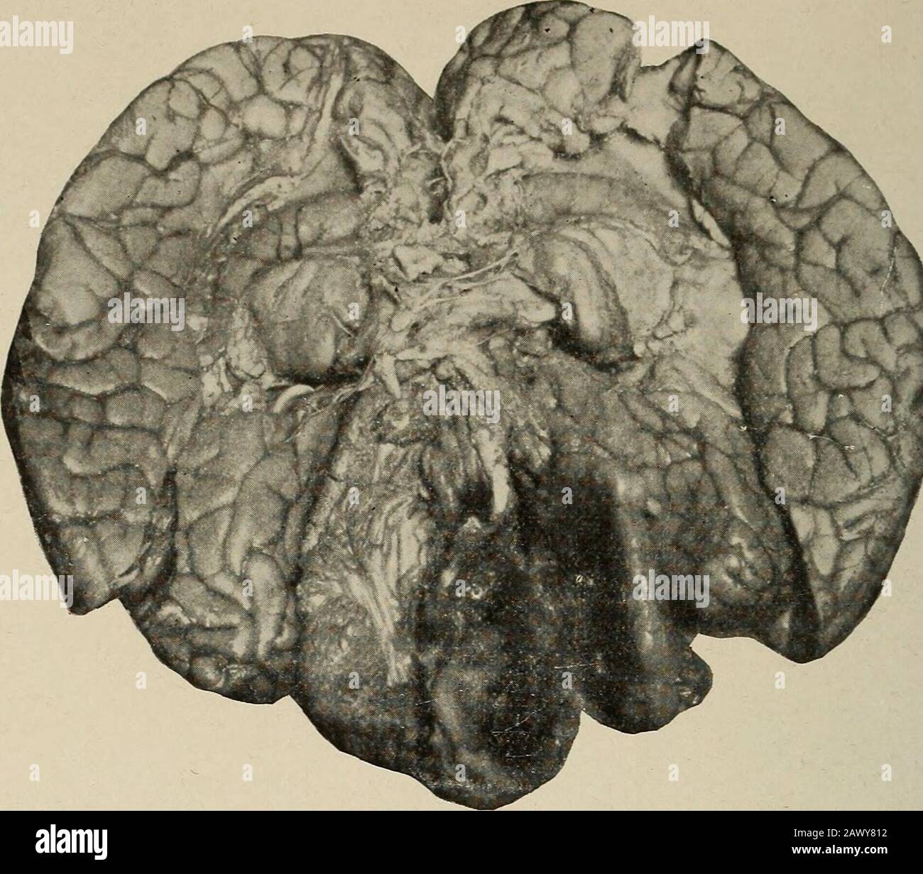 Malattie nervose e mentali. Colore vascolare e consistenza asoft abbastanza come quella della sostanza cerebrale. Il glioma è un'infiltrazione emi-nently e una crescita distruttiva. I suoi contorni sono difficili da determinare. A causa del suo effetto di strangolamento, il centro di un glioma è spesso riempito di detriti ammorbiditi e di prodotti di degenerazione grassa, che possono diventare fluidi e la crescita cistica. Molti allegedlocal cervello-ipertrofei sono stati infatti gliomatous infiltrazione, e l'esame microscopico di cisti-pareti ha solo scoperto la vera natura della lesione in altri casi. La favo Foto Stock