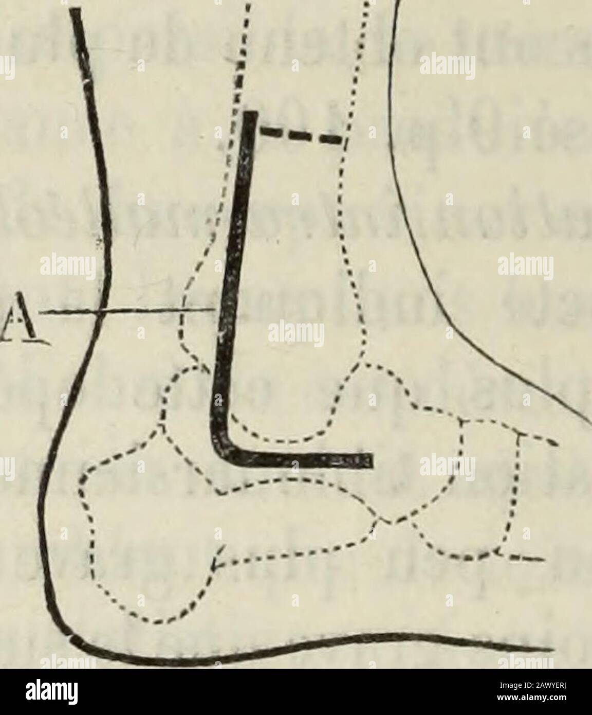 Nouveau Dictionnaire De Medecine Et De Chirurgie Pratiques Fig A Reseclion Du Calca Neum Ollicr Resection Dueou De Pied Perone Fig 85 A Resection Du Cou De Pied Tibia Moreau Fils Sciait Los Darriere