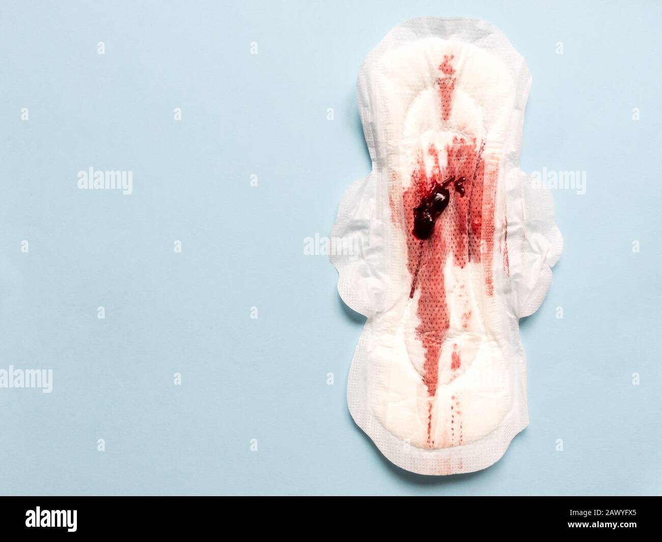 Sintomo di endometriosi, sangue mestruale con coaguli di sangue su un assorbente igienico. Foto Stock