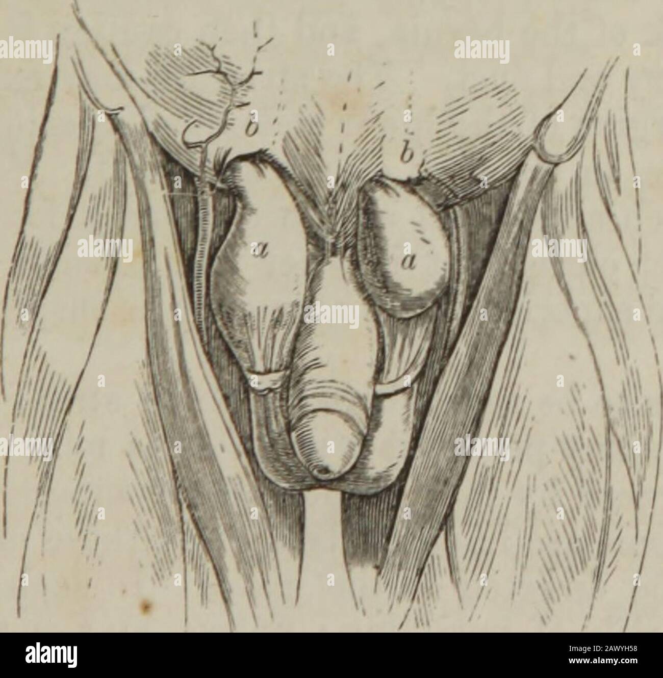 La pratica della chirurgia . al ai parietes, all'apertura inferiore, e da qui scende nello scroto nel maschio, consti-tuting un oscheocele, o ernia scrotale ; nel labio della femmina, che costituisce ernia labiale. Gli investimenti del tumore sono come fol-lows : esternamente, l'integumento; poi la fascia superficiale del theaddome; poi la fascia propria, o fascia propria di Camper, consiste-ing di fibre dal tendine dell'obliqui esterno; poi la fasciacremasterica, costituita da fibre dal muscolo cremaster; poi teinfundibuliform, o fascia di transsalis, consistente di Foto Stock
