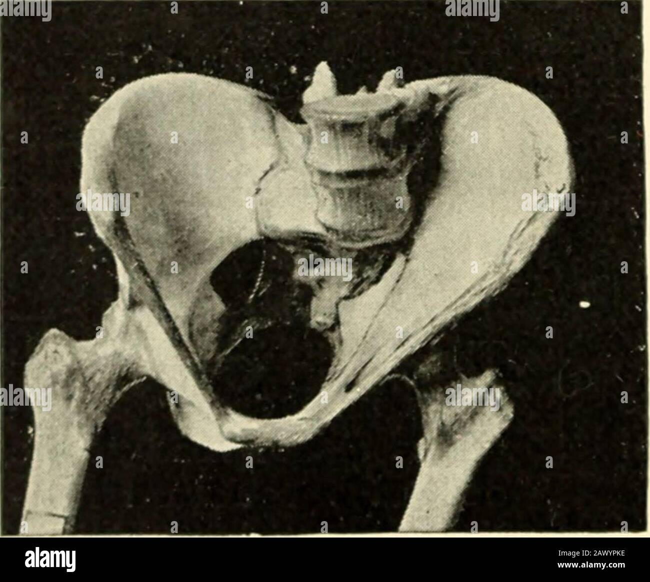 Un libro di ostetricia . sotto richiesta Cesarean sezione. In gradi minori le donne possono essere consegnate spontaneamente o con le pinze. Obliquamente Contrasse Pelvi da uno sviluppo Imperfetto di theAla su Una SME del Sacrum [Naegele Pelvis].- Questo bacino fu descritto per la prima volta nel 1834 da Franz Carl Naegele,1 ma era stato notato fin da 1779without una comprensione completa del suo significato (Fig.290). Caratteristiche. 1 l'ingresso epelvico ha un'ovalizzazione, con il piccolo puntodell'ovale diretto sul lato atrofizzato del thesacrum. L'ala sacrale è isatrofiata o è assente notsoltanto in quella parte del theb Foto Stock