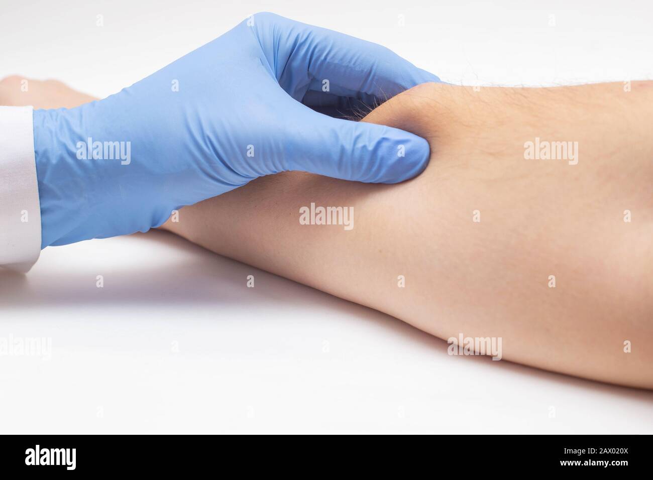 Il dermatologo medico esamina il wen sottocutaneo sul braccio del paziente, da vicino. Cancro della pelle, concetto di malattia maligna, testudo Foto Stock