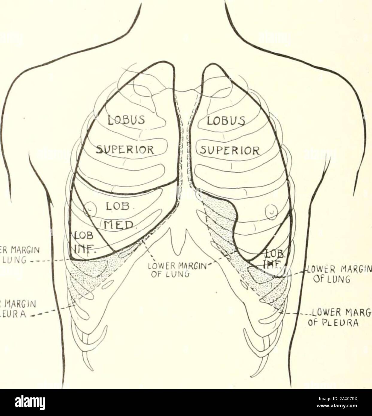 Tubercolosi clinica . lei. L'infezione bronchogenica, per la mostparte, segue lo stesso decorso, ma può, come la in-fezione ematogena, anche passare da un lobo all'altro, o da un polmone all'altro. Le divisioni tra i lobi sono mostrate nelle Figg. 51, 52, e 53.Clinicamente, la divisione tra il lobo superiore e quello inferiore può essere marcata in modo loughly posizionando la mano sulla spalla opposta, che getta il punto inferiore della scapola verso la teaxilla, e tracciando una linea lungo il suo bordo interno. Questa linea quandoprolungata, come in Fig. 57, pag. 324, indica approssimativamente la divisione tra i lobi. Foto Stock