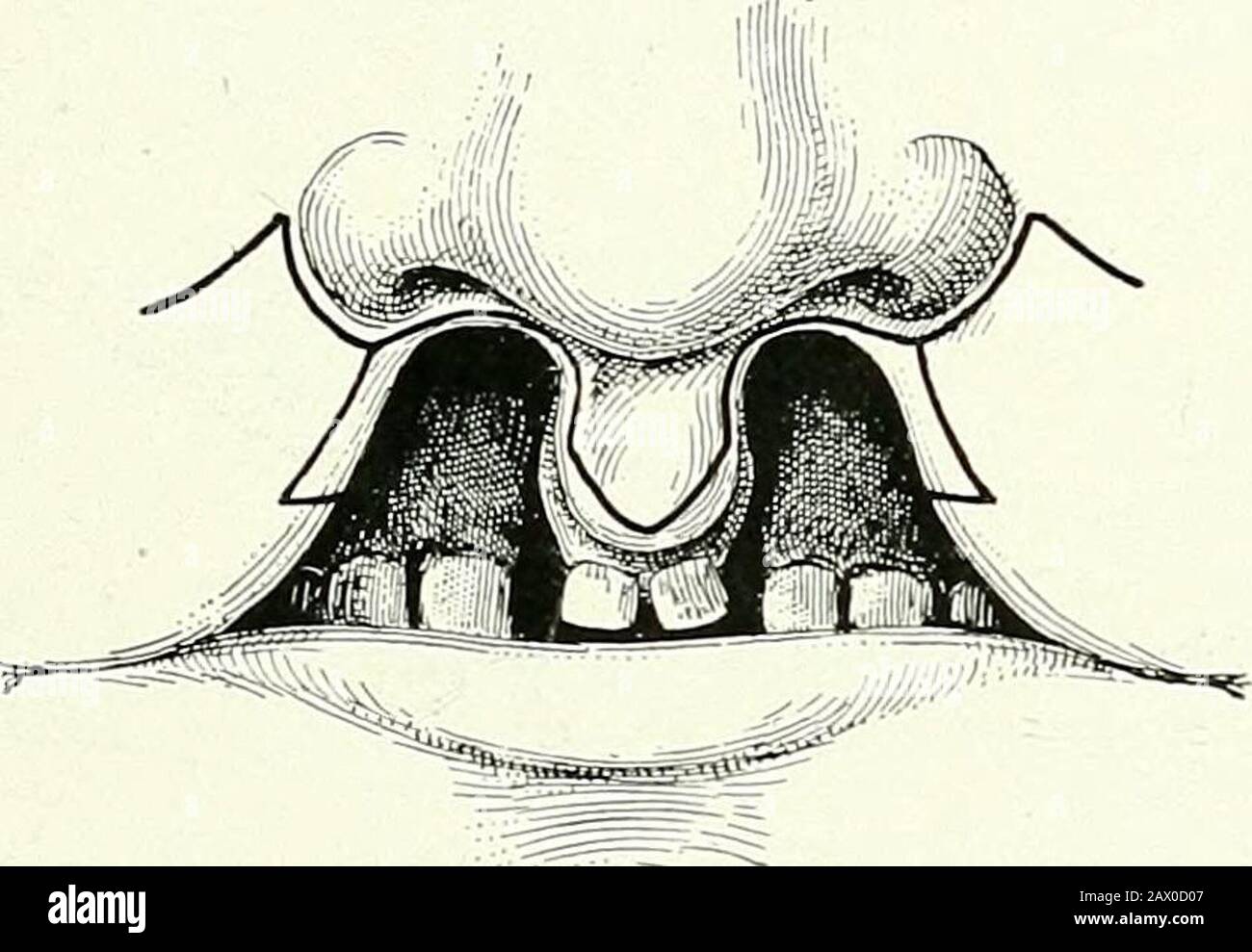 Terapie chirurgiche e tecniche operative . Fig. 18.- Semplice Labbro Bilaterale Lepre. Spostamento di scorrimento delle alette laterali ecoaptazione. Foto Stock
