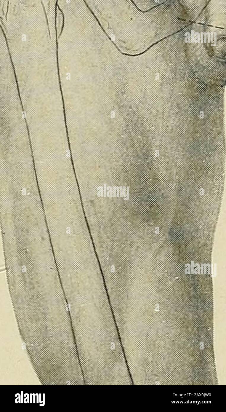 La BNA è disposta come contorno di anatomia regionale e sistematica. La regione posteriore del ginocchio, che si estende per circa 10 cm. Distale e prossimale alla linea di articolazione del ginocchio; (fo) trasversalmente all'estremità posteriore dell'incisione precedente. Fascia superficiale - 23 :36. Nervo cutaneo femorale posteriore - 70:51. Solo rami terminali.vena safena piccola: 56 :1.vena femoropoplitea: 56 :2.fascia Profonda: 27 :70. 3. SPAZIO POPLITEO; NEVES LAEGE E VASI. Può essere esposto facendo un'incisione longitudinale attraverso il fasciato profondo la linea mediana dello spazio popliteo, riflettendo la fascia e de Foto Stock