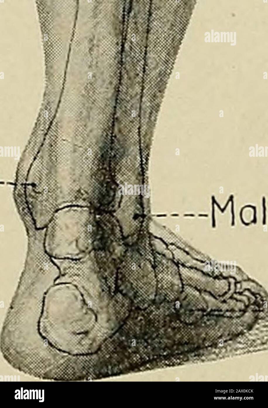 La BNA si è posta come un profilo dell'anatomia regionale e sistematica . Molleolus medialis tibiae-|i. Malleolo lateralis fibulae Tuberositas oss.metctarsalio V ESTREMITÀ INFERIORE I. Caratteristiche generali dell'arto Inferiore. 1. SUDDIVISIONI. Thig-h-5 :45. Superficie anteriore e posteriore: 5 :46, 47. Superficie laterale e mediale: 5 :48, 49.Solco Gluteo: 5 :50.ginocchio: 5 :51. Superficie posteriore del ginocchio: 5 :52. Rotula - 5 :53.Leg - 5 :54.Foot - 5 :60. Per le restanti suddivisioni della gamba e del piede, vedere VII :1a.Per l'osteologia dell'estremità inferiore vedere 15:5-17:45. 2. EEGIONS. (Pis. 11, 12.) Reg Foto Stock