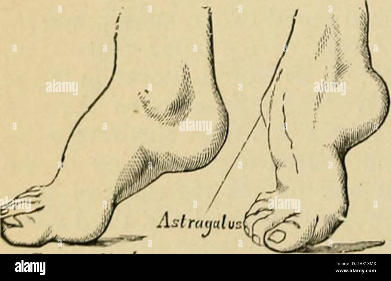 Chirurgia; la sua teoria e pratica . Talipesequiniis, varus, calcaneus, valgo e cavus. Ma queste possono essere variamente combinate, producendo forme composte, che sono cosiddette equino-varus, equino-valgus, calcaneo-valgus, ecc. T. Talipes equimis (figg. 370, 371) è quasi sempre un affetto acquializzato, e generalmente dovuto alla paralisi infantile dei muscoli anteriori o estensori; come affetto congenito è veryrand. Ho visto solo due casi durante i dodici anni ho avuto carica del reparto ortopedico a St. Bartholomews.The tallone è disegnato verso l'alto dal tendo Achillis, e l'ante Foto Stock