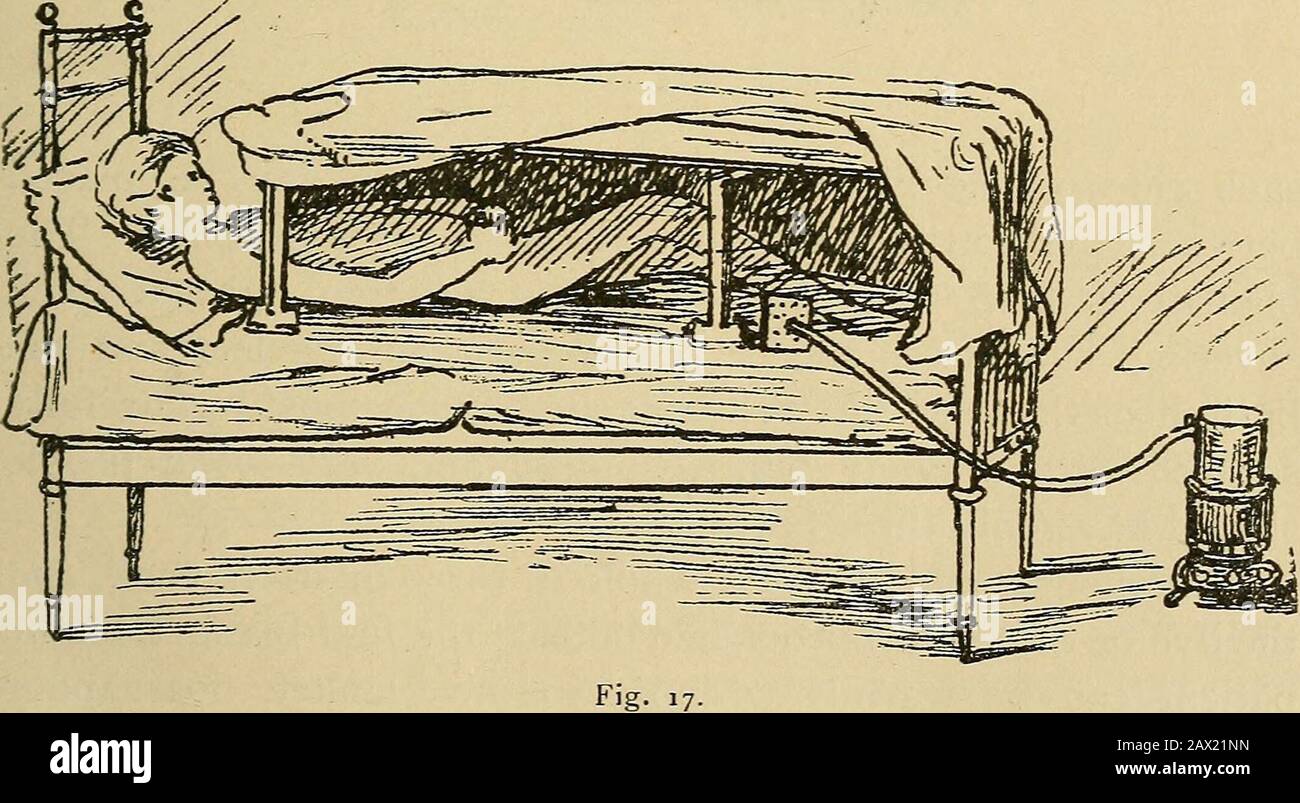 La cura della natura tedesca, e come praticarla . Fig. I6. BAGNO TURCO A LETTO. 57 trattamento attivo, come un bagno d'anca, o un stimolante pacchetto di vita dell'anca durante la notte, con impacchi per gambe o piedi; anche acquerottazione, impasti di ginocchio, bagni derivati per i piedi, e ultimo, non meno importante, con passeggiate a piedi nudi. [PLATINA.) BAGNI DI VAPORE A LETTO. Si tratta di una forma molto delicata di bagno di vapore, e può essere givento infanti così come per le persone anziane. Hanno avuto origine da Rikli, e per loro ha inventato un apparecchio regolare. La mattressis coperta da un grande pezzo di impermeabile, su cui è posata una coperta di lana di lamiera, su cui è stata posta Foto Stock