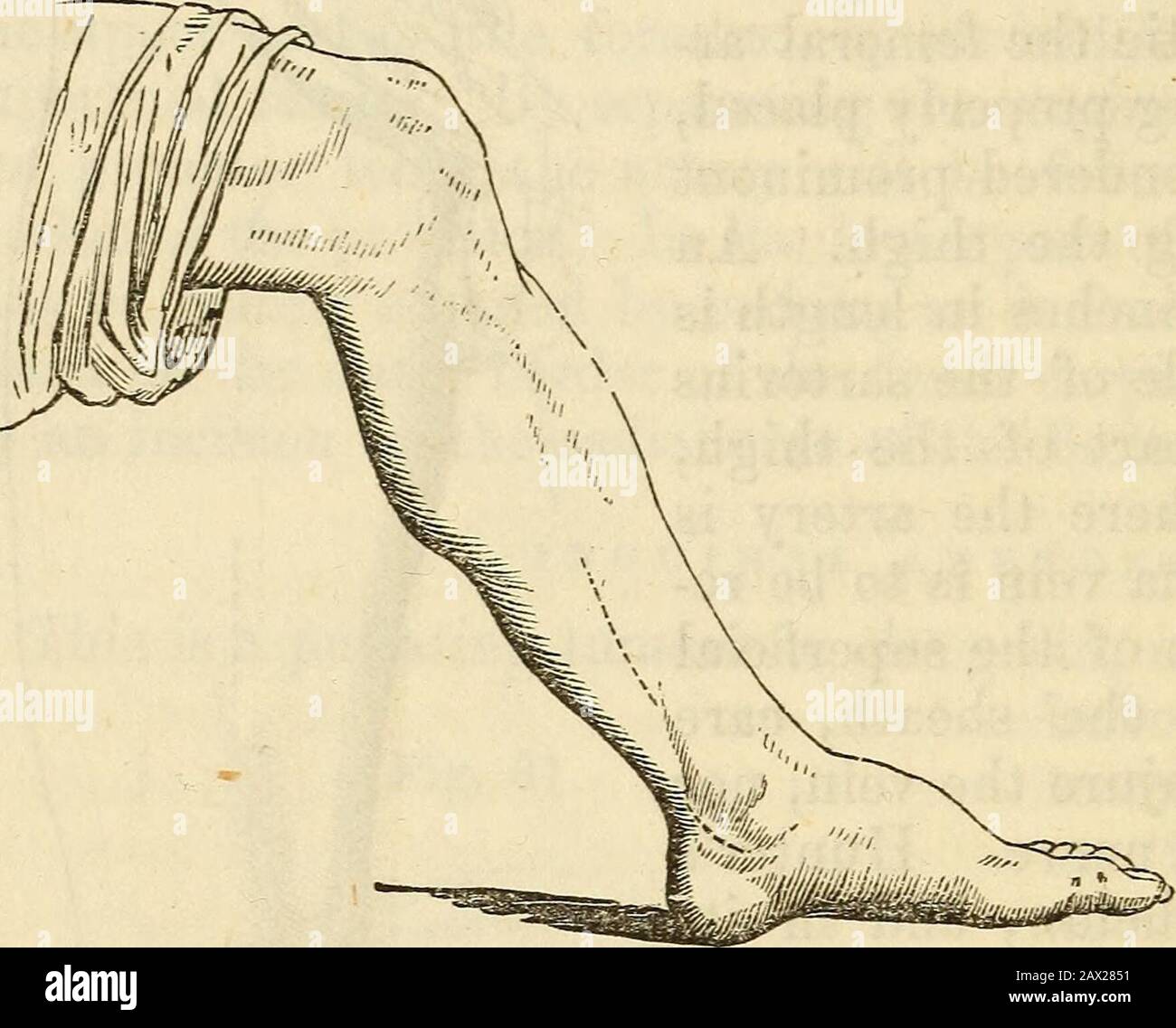 Un manuale di chirurgia: Con cinquanta illustrazioni . 108 CHIRURGIA. Il extensor proprius poUicis. Le venae comites e il tibialnervo anteriore devono essere evitati. All'interno l'arteria può essere assicurata facendo un'incisione sul lato fibulare del tendine del pollicis extensor proprius. La tibia posteriore può essere prontamente legata vicino al centro della gamba, sul lato interno; dividere la pelle, la fascia superficiale, la fascia cru-ral, e someFig. 34. le fibre del soleo, e la gamba flessa, il sursecano tricipite, devono essere messe da parte^jh^^ . sufficientemente da esporre ! J Mil II ?????-? ? A la guaina Foto Stock