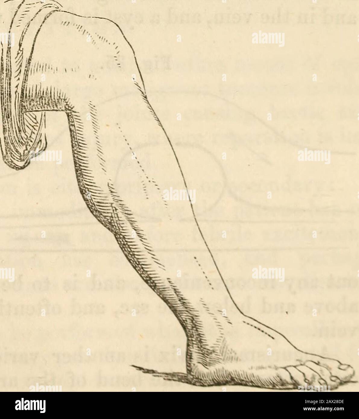 Un manuale di chirurgia: Con cinquanta illustrazioni . Fig. 33.. 108 CHIRURGIA. Il extensor proprius poUicis. Le venae comites e il tibialnervo anteriore devono essere evitati. All'interno l'arteria può essere assicurata facendo un'incisione sul lato fibulare del tendine del pollicis extensor proprius. La tibia posteriore può essere prontamente legata vicino al centro della gamba, sul lato interno; dividere la pelle, la fascia superficiale, la fascia cru-ral, e someFig. 34. le fibre del soleo, e la gamba flessa, il sursecano tricipite, devono essere messe da parte^jh^^ . sufficientemente da esporre ! J Mil II ?????-? ? A t Foto Stock