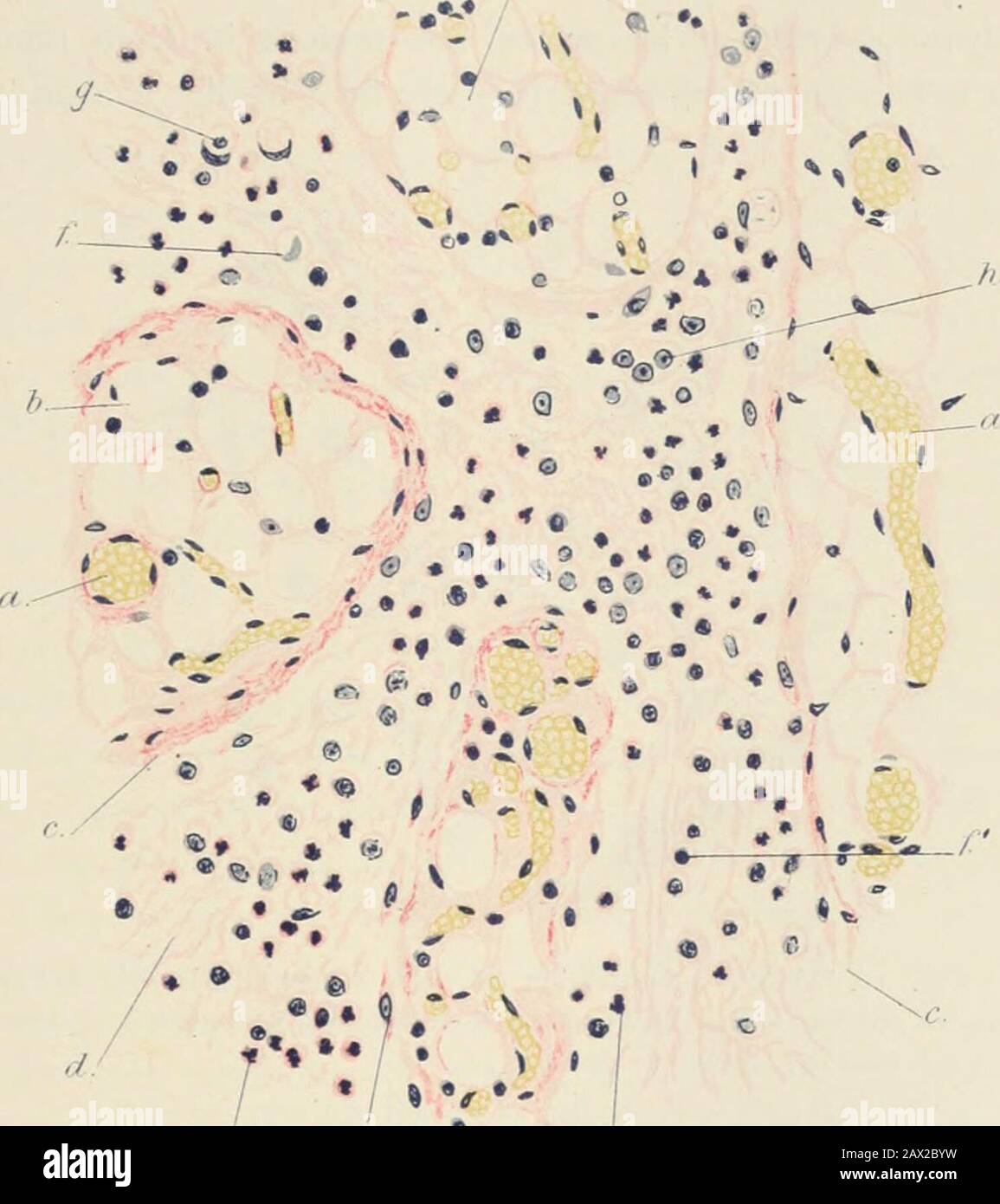 Patologia pratica; manuale per studenti e professionisti . â â -â . - UU, â ^a^- *V*^- a.. Fui. II.âSection di omenUini infiammati mattati. Macchiato con withahmi ha;maleina e picro-eritrosina. ( x 50.) a. Superficie sierosa dell'omentum con trabecule fibroso sottostante. B. Cellule grasse. C. Vasi sanguigni piccoli. D. Linfa fibrinosa in cui sono incorporati molti leucociti polimorfo-nucleari. Vicino alla superficie peritoneale sono presenti cellule endoteliali rigonfiate e proliferanti ma non possono essere disinguite molto facilmente dal leucocitesunder polimorfo-nucleare questo ingrandimento. Essere quasi i)i situ, ma distaccate Foto Stock