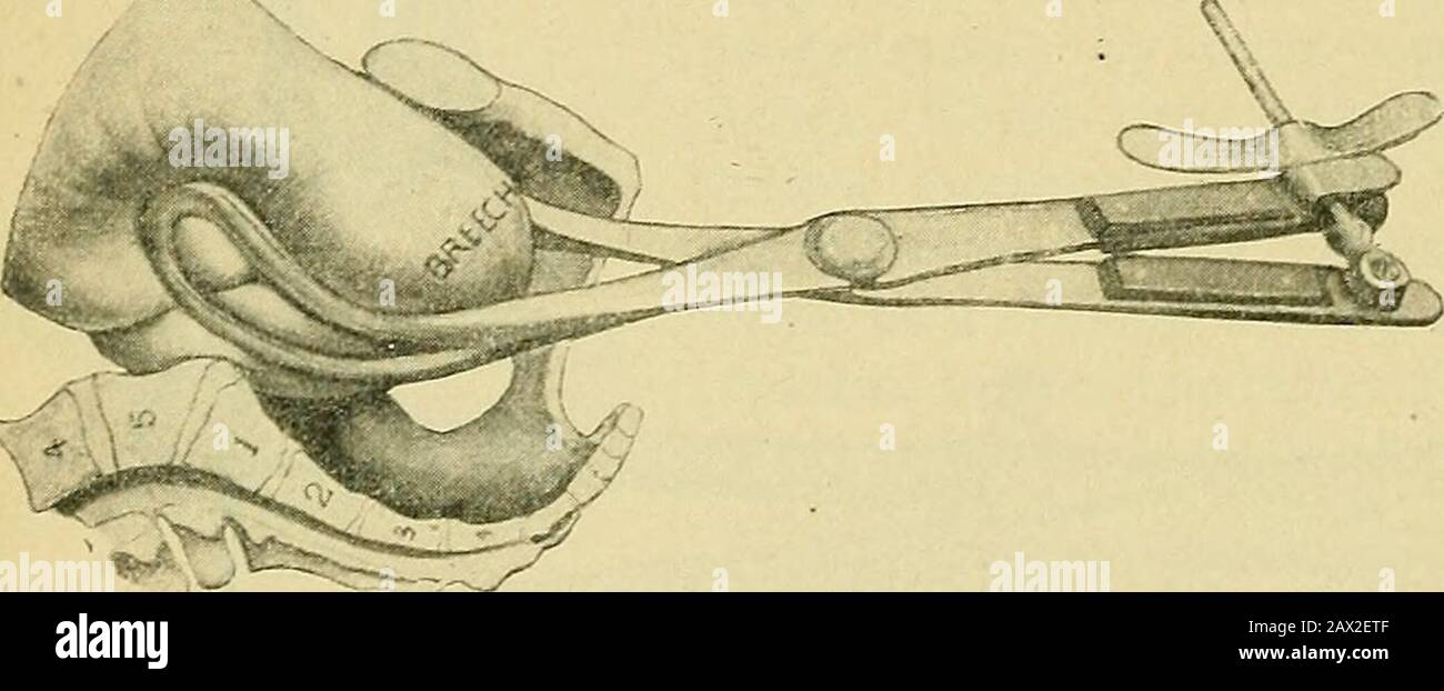 La pratica dell'ostetricia, progettata per l'uso di studenti e professionisti della medicina. T essere rimossa e riapplicata in un diametro trasversale o obliquo, o, meglio, il cranio-clast sostituito. La COM-pressione con la vite a mano dovrebbe sempre essere afflitta, e ripetute esplorazioni digi-tal dovrebbero essere fatte per rivelare le spicole pro-getting dell'osso.CephalotribeOperation basso. La lama inferiore sinistra è dapprima in-troduta all'altezza del diametro pelvico obliquo trasversale secondo la posizione della presente, seguita dall'applicazione della lama destra o superiore; grande attenzione beingu Foto Stock