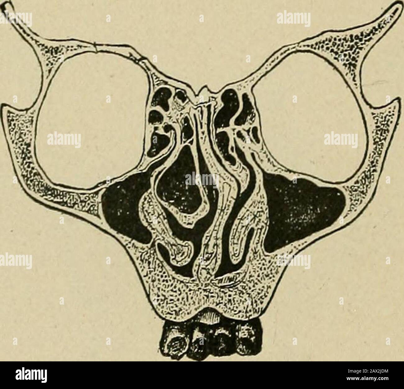 L'eziologia delle deformità osee della testa, del viso, delle mascelle e dei denti. nt deve essere necessariamente in possesso di una condizione degenerata, con polmoni deboli, vaiolo e bassa vitalità. Affinché l'aria possa essere riscaldata uniformamente il setto si è deflesso verso destra. Il vomero si è deflesso verso destra in modo che l'EZIOLOGIA 268 DELLE DEFORMITÀ OSSEI dell'osso torbiato possa avere spazio, ed anche per fornire uniformità. Il setto in questo caso è piegato e non rotto. Fig. 81 è un'altra forma di deformità che ho osservato a livello di forma. In questo disegno si osserva che le nasalcavità ex Foto Stock