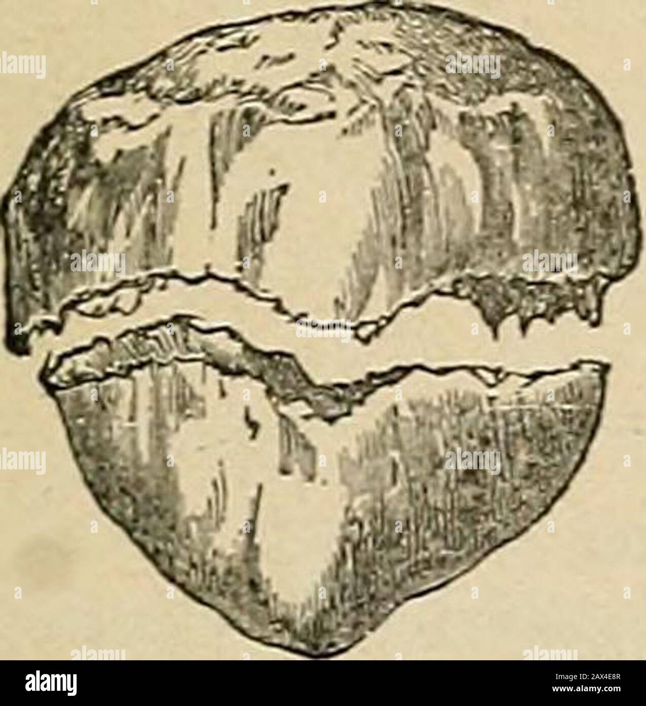 Chirurgia; la sua teoria e pratica . muscolo xtensor, come è esercitato da una persona per riguadagnare la posizione eretta quando si sente scivolare indietro, il ginocchio essendo poi semi-flesso, e la rotula non supportato. A volte sono causati?da violenza diretta, come un colpo o caduta sul ginocchio. Stato delle parti. - Quando a causa dell'azione muscolare la linea della frattura si estransverse (Fig. 195), la copertura aponeurotica è solitamente lacerata, e il frammento superiore generalmente ha disegnato una certa distanza dal tosaerba per l'azione dell'estensore quadricipite. Quando dovuto la violenza diretta è più spesso starred o vert Foto Stock