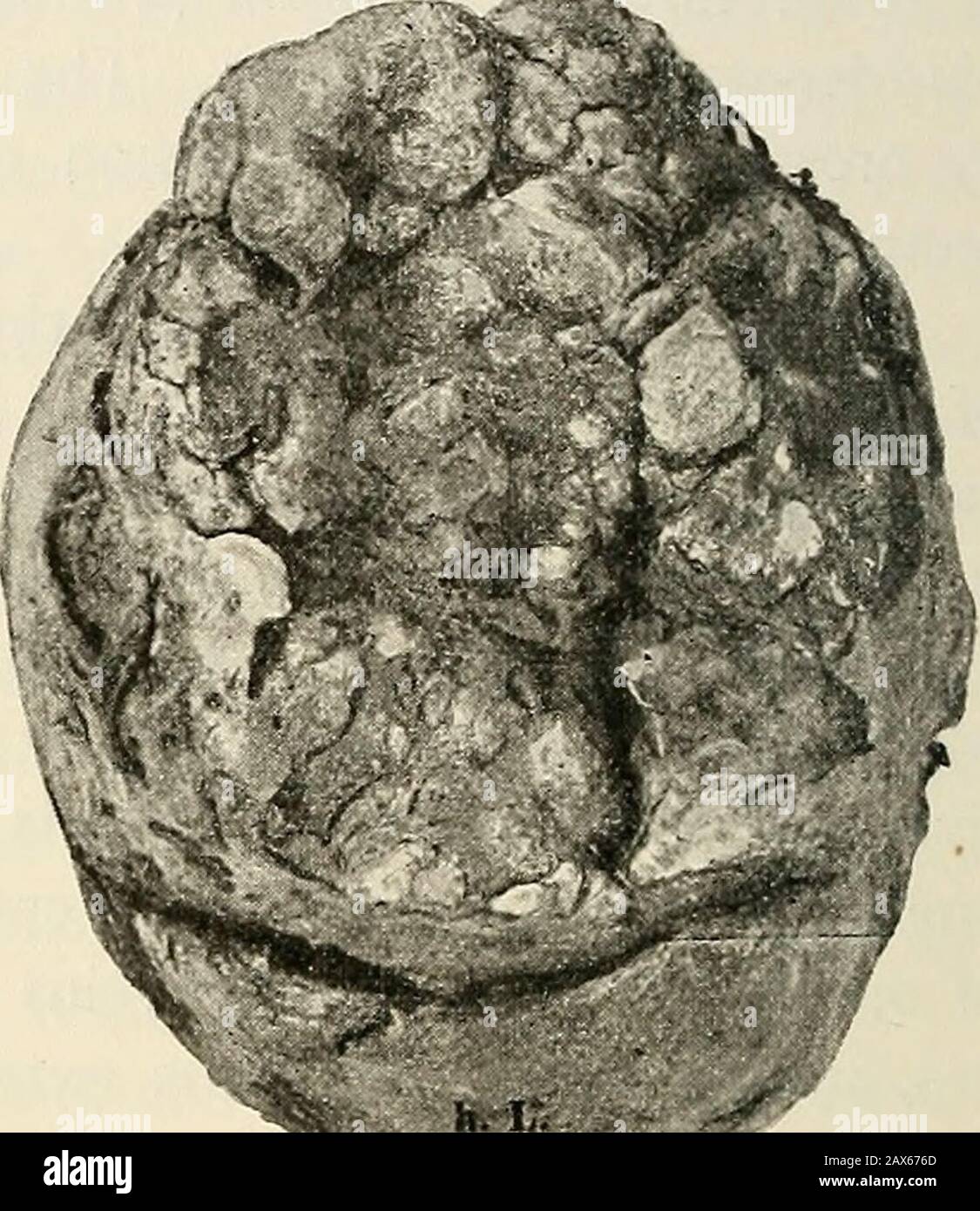 Atlante ed epitome della ginecologia . Fig. 34.-atrofia cirrotica senile  dell'ovaio.. Fig. 35.-degenerazione oligocistica dell'ovaio. Infiammazioni  dei tubi. (Fig. 36.) Questa osalpingite dell'oforo è combinata con la  peritrosalpingite, la peri-metro