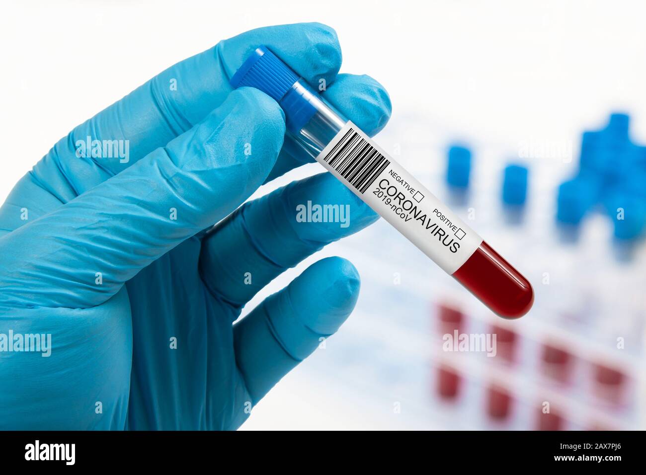 Campione di sangue di coronavirus in laboratorio. Nuovo virus umano 2019-nCoV a Wuhan, Cina. Foto Stock