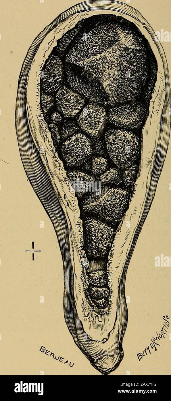 Calcoli della gall e malattie dei dotti biliari . fiVTT£/?Wofcjfia Fig. 24.- UNA pietra solitaria in una cistifellea contratta (Museo del Royal College of Surgeons). Hanno visto un esempio di questo in una sottile, emaciated oldwoman. Quando una cistifellea contiene due grandi calcoli e si contrae su di esse assume una forma ad ora di vetro, e se viene bisecata le due por-zioni distese saranno trovate separate da UNA MALATTIA 6Q perforata del diaframma DEI DOTTI BILIARI. Le camere d'aria biloculari sono comuni, e occasionalmente, quando contengono diverse pietre di dimensione offair ciascuno, possono essere alloggiate in una cavità e pro-. Fi Foto Stock