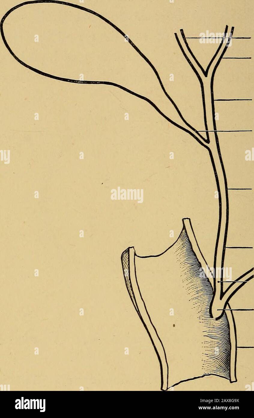 Calcoli biliari e malattie dei dotti biliari . Fig. Sezione Trasversale di un canale portale. (Dopo Schafer.) nella seconda parte del duodeno. I largedotti e la cistifellea costituiscono l'apparato escrementivo del fegato e sono di tale importazioneche ciascuno richiederà una descrizione dettagliata. L'apparato escretorio del fegato. - questo composto del dotto epatico, del dotto cistico, della cistifellea e del dotto biliare comune (Fig. 2). Il dotto epatico, formato dall'Unione DELLE 4 MALATTIE del dotto epatico destro e sinistro DEI DOTTI BILIARI, ha un diametro medio di 4 mm, e di lunghezza variabile fr Foto Stock