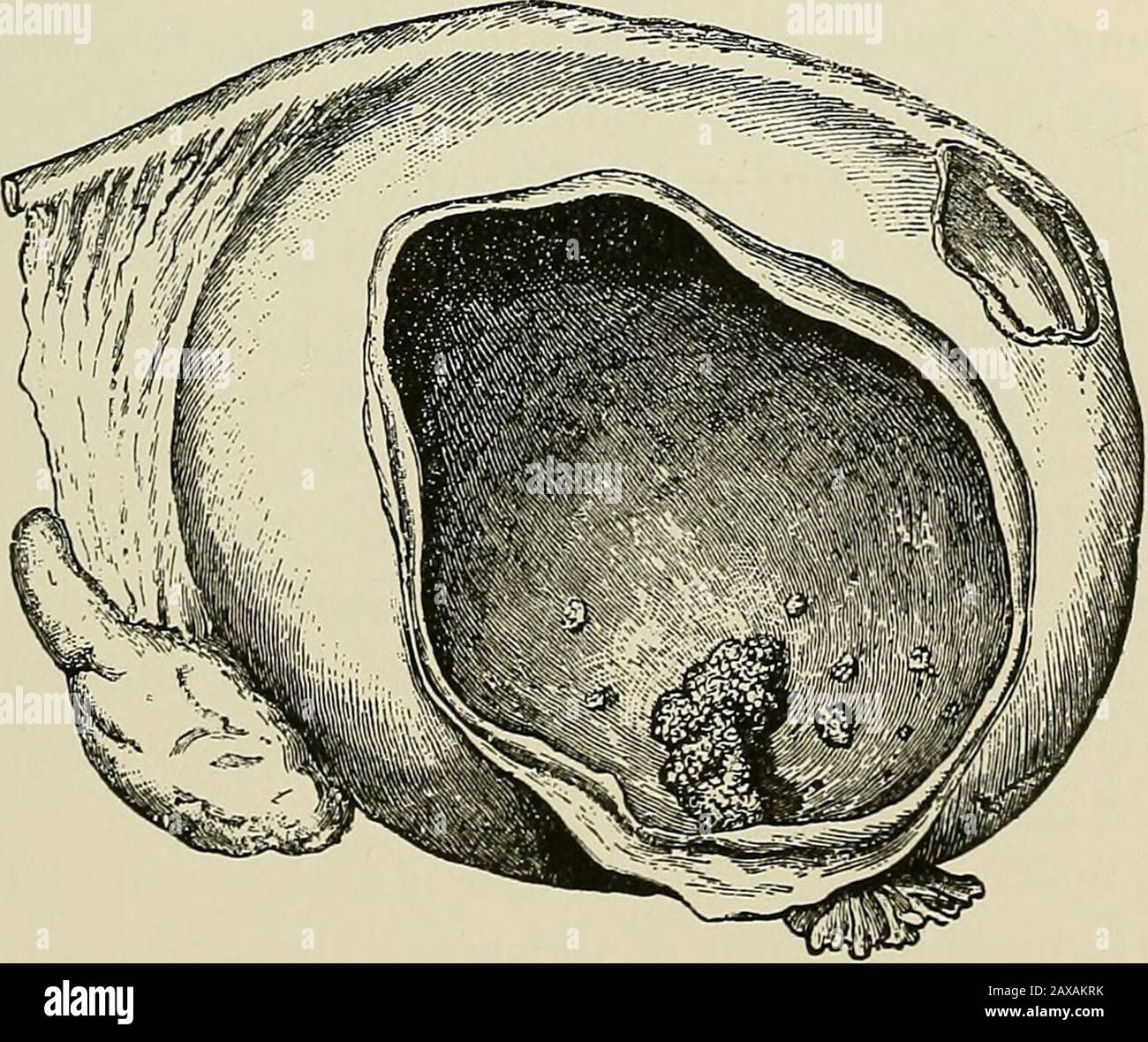 La patologia e il trattamento chirurgico dei tumori . Fig. 100.-malattia cistica delle ovaie: Cisti follicolari multipli sierose e mixomatose (dopo pozzi):a, a, cisti mixomatose piccole; cisti b,b, cisti mixomatose grandi; e, e, cisti follicolari con contenuto fluido; cisti follicolari stSt con contenuto caseo; o,f,/, tessuto ovarico contenente cisti follicolari piccoli. Le sacre epiteliali di Waldeyer, così come i tubuli midollari di Kolliker, possono dare origine alla formazione di cisti, ma che dal primo. Fig. Cisti Papillare a partire dall'ilus dell'ovaio (aftor Doran). Sul lato inferiore sinistro ex Foto Stock