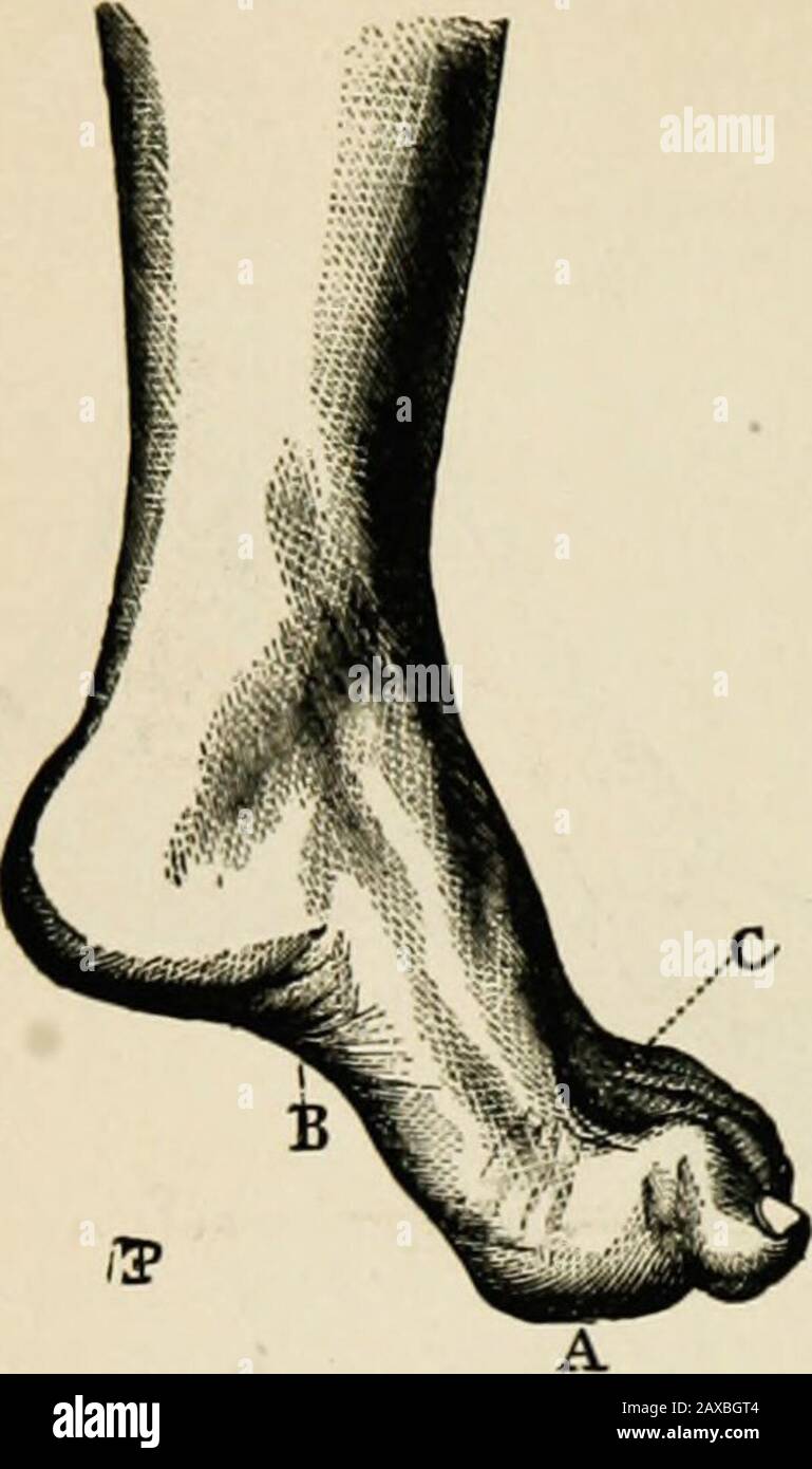 Un trattato sulle malattie nervose dei bambini, dei medici e degli studenti . Fig. 23.-Superficie Plantare Dello Stesso Piede, cambiamenti di esposizione dovuti a con-trazione di PeroneusLongus, accorciamento di Diametro trasverso AC, e torsione Del Piede. Fig. 24. Stessa Posizione Piede.Valgus a causa della Causa del domoSame. Fig. 25. – Piede Clawed fromtrofeo di Interossei e Muscoli otherIntrinsic Del Piede. (Du-Chenne.) 32 LE MALATTIE NERVOSE DEI BAMBINI. Fig. 26. Pes Equino in BoyFive Anni di età da Atrophyof Tibialis Amicus. Foto Stock