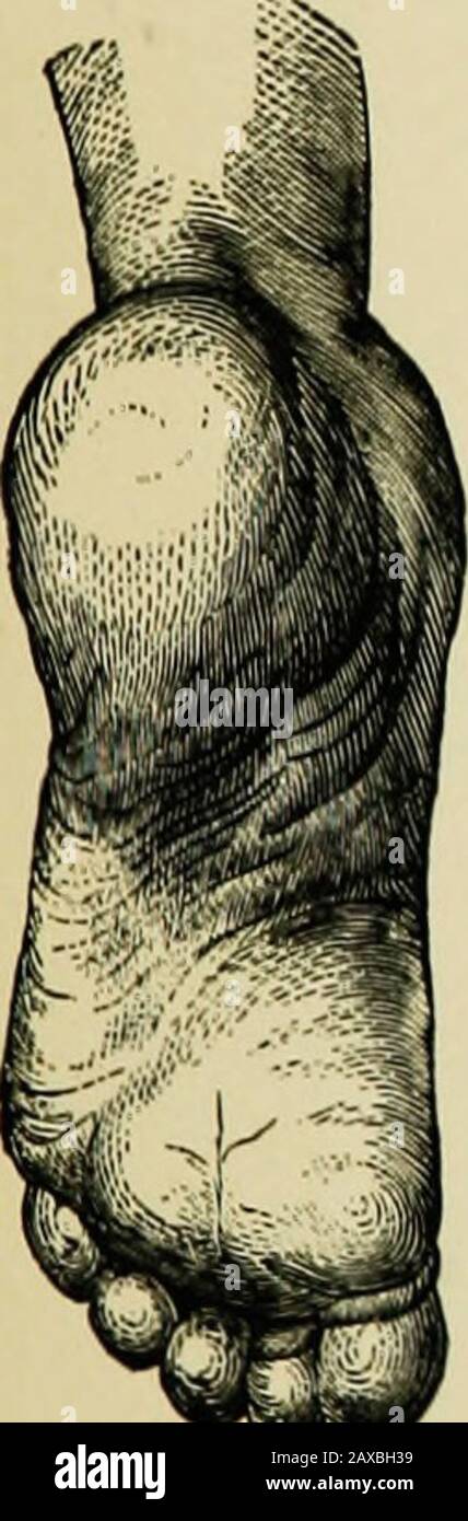 Un trattato sulle malattie nervose dei bambini, dei medici e degli studenti . Fig. 21.- Promminenza Submetatarsica. ALower che Normal, e IncreasedPlantar Arch, derivanti dal Contract-ure di Peroneus Longus. Fig. 22.-Esporre, Inoltre, Promi-nence del Tendon del PeroneusLongus F. (Duchenne.). Foto Stock