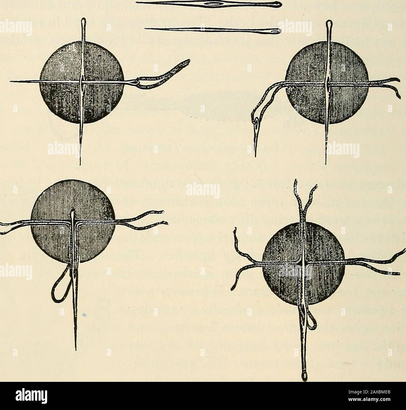 Atlante ed epitome della ginecologia . Fig. 34.-atrofia cirrotica senile  dell'ovaio.. Fig. 35.-degenerazione oligocistica dell'ovaio. Infiammazioni  dei tubi. (Fig. 36.) Questa osalpingite dell'oforo è combinata con la  peritrosalpingite, la peri-metro