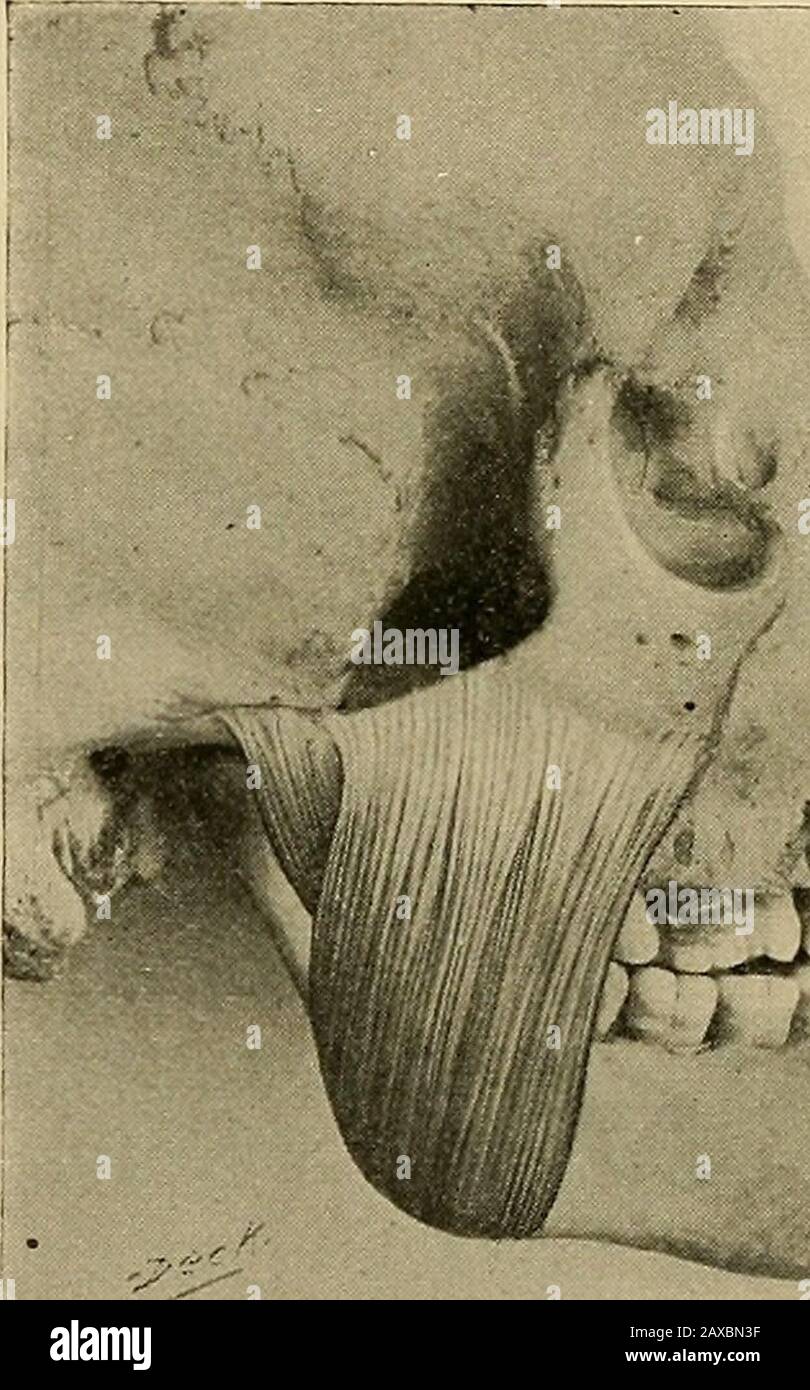 Anatomia applicata e chirurgia orale per gli studenti dentali . pterygoid.The muscoli accessori sono buccinator, platysma mioides, digastric, mylohyoid, geniohoid. Il muscolo temporale deriva dalla fossae temporale dalla fascia temporale. Viene inserito nel processo della mandibola. È supposta da un ramo della divisione mandibolare del trifacialnerve. La funzione del muscolo temporale è quella di tirarla verso l'alto e all'indietro. Il muscolo massaggiatore è costituito da una porzione superficiale e da una porzione profonda (Fig. 15). La raffigosuperficiale deriva dai due terzi anteriori del lowe Foto Stock