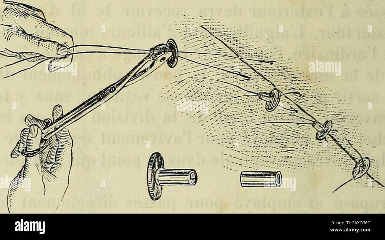 Manuel de médecine opératoire . ste à opérer la strriction. Dabord, pour riapprovcher les bordsde la plaie, Bozeman uno strumento spécial dit ajusteur de la 700 OPÉRAZIONI SPÉCIALES. Sutura. Il centro di dun petit disqueaplati percé dun Trou à figlio. Dans ce trou il Engage lesdeux bouts de chaque fil, et tdis quil les tend de la maingauche, il fait glisser le disque jusque sur la plaie, de manièreà en procurer laffrontement Exact, et à imprimer aux fils la formedun anneau il quil ne sagit Plus que de serer. Alors, nouvel ins-trument. Il a pris soin de préparer, AV Foto Stock