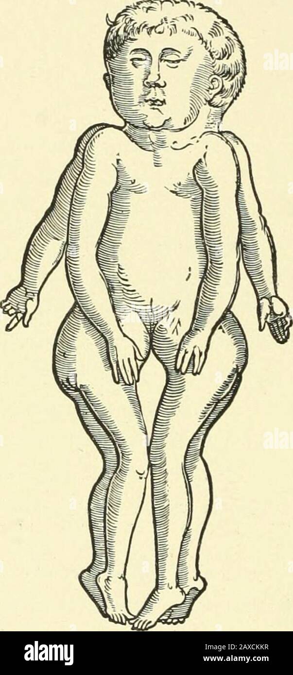 Wunder, Wundergeburt und Wundergestalt in Einblattdrucken des fÃ¼nfzehnten bis achtzehnten Jahrhunderts; kulturhistorische Studie . Denn zunÃ¤chst Hat er, als fÃ¼r ihn offenbar unwichtig, die Nabelschnur weggelassen und ihren (gemeinschaftlichen) Ansatz. Es kamihm offenbar in erster Linie darauf an, zu zeigen, daÃ hier ein Wesen in dieWelt geset5t wurde mit vier Beinen und vier Armen und einem zusammen-gewachsenen Rumpf. Es ist aus dem Bilde auch nicht ersichtlich, ob einoder zwei Gesichter vorhanden waren, ferner auch nicht, welchem Geschlechtdiese beiden Kinder angehÃ¶rten. Auf alle FÃ¤lle ab Foto Stock