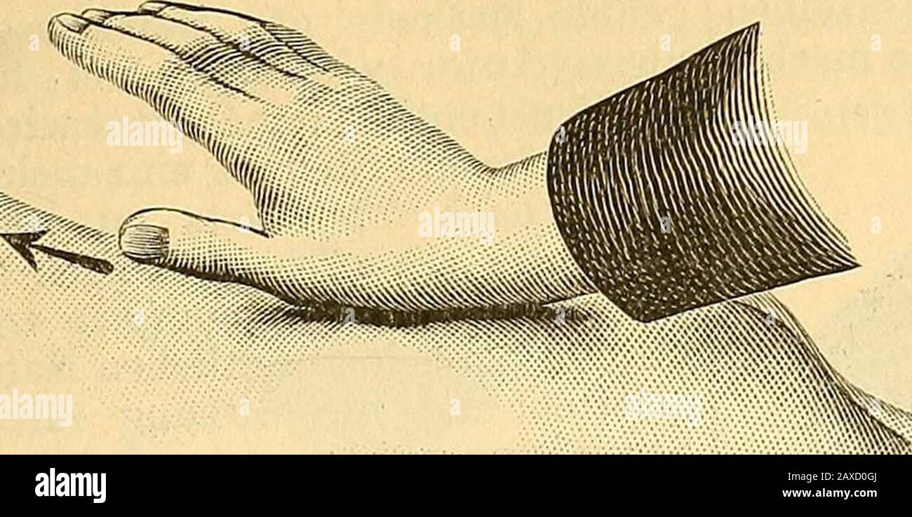 Therapeutisches Lexikon : für praktische Ärzte . ne Hand-theile. Wir verwenden daher zurVornahme der Streichung die Volamanus (Fig. 1), die Volarflächender gekreuzten Finger im Vereinemit der Flachhand (Fig. 2; dieHand des Kranken ruht auf einerStuhllehne oder ist durch eine aneinem Nagel befestigte Bandansaxirt), den „Kammgriff (Fig. 3), denDaumenballen (Fig. 4;pag.99.3), dieDaumenspitze (Fig. 5), die Volar-seite der Endphalangen der Daumen(Fig. 6), die Fingerspitzen (Fig. 7;pag. 995), u. Der Handgriff be-zweckt Beschleunigung des Lijmpli-imd Blutstromes.- b) Reibung (Massaggio ä attrito Foto Stock
