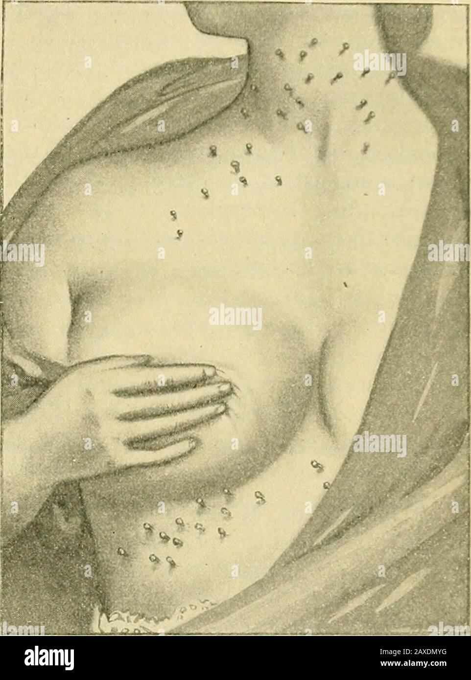 La pratica dell'ostetricia, progettata per l'uso di studenti e professionisti della medicina. Menon in stato preg-nant o immediatamente seguitandolo. Dei due periodi, è oftener sviluppato post partum che nel corso della gravidanza. C'è una possibilità, tuttavia, che la caduta è notata solo quando i capelli sono diventati sottili. La caduta è generale, ma le regioni temporali sono principalmente interessate. È raro che qualsiasi parte sia completamente denudata. Sembrerebbe probabile che questo affetto sia classificato con l'alopeciasof febbri prolungati. In caso affermativo, è un disturbo nutrizionale nella h Foto Stock
