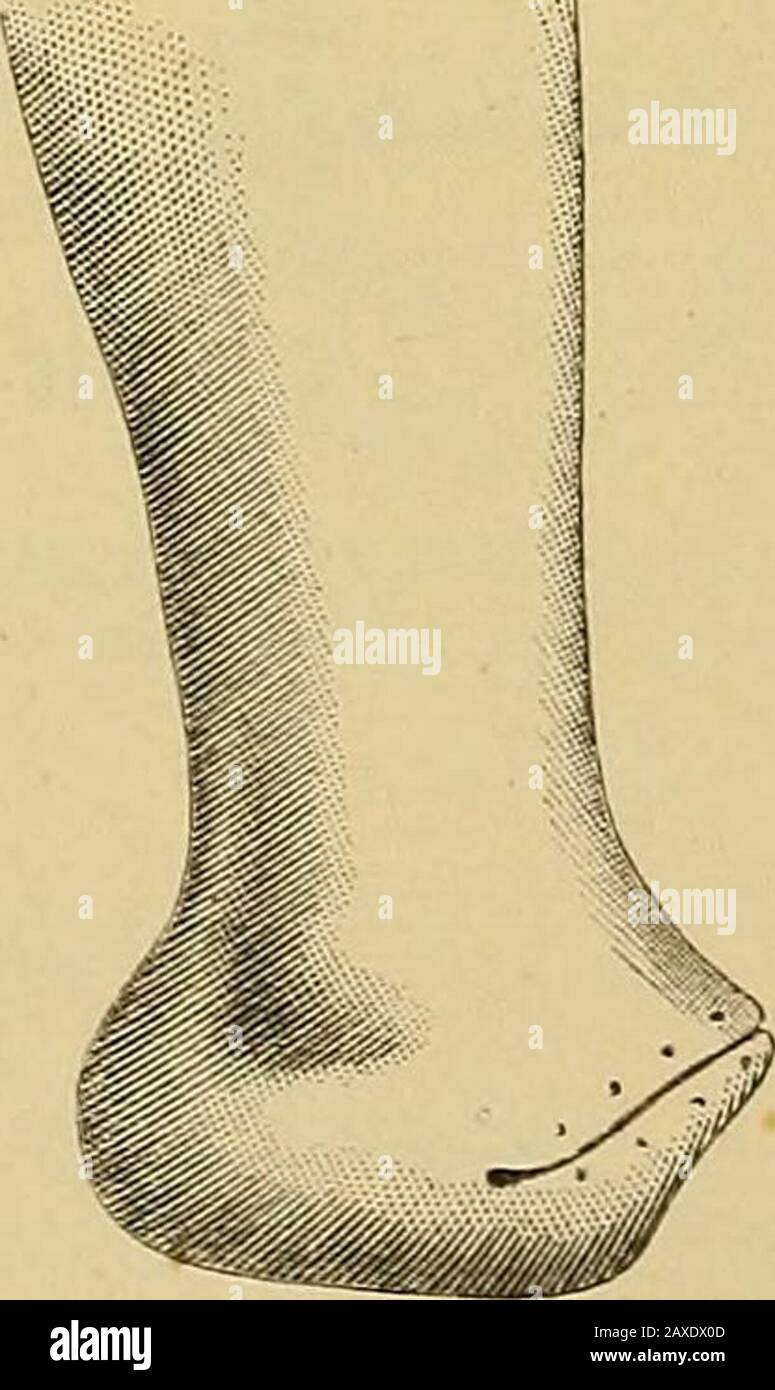 Il manuale del chirurgo sul trattamento dei feriti in guerra : un saggio premio . Disarticolazione attraverso il tarso (CHOPART). (Completamento della falda plantare.) dopo l'operazione CHOPARTS. M Fig. 381. h. Disarticolazione del Subastragaloid (Malgaigne). 1. Due lembi laterali sono formati da un'incisione, che si diramando immediatamente al di sopra della grande tuberosità del calcis del os e che divide il tendo Achillis. L'incisione poi si dilata sulla metà inferiore del calcagno con un'ampia curvatura al di sotto del malleolo esterno (fig. 380); da qui sale trasver-samente sopra la metà del cuboide a thedorsum del Foto Stock