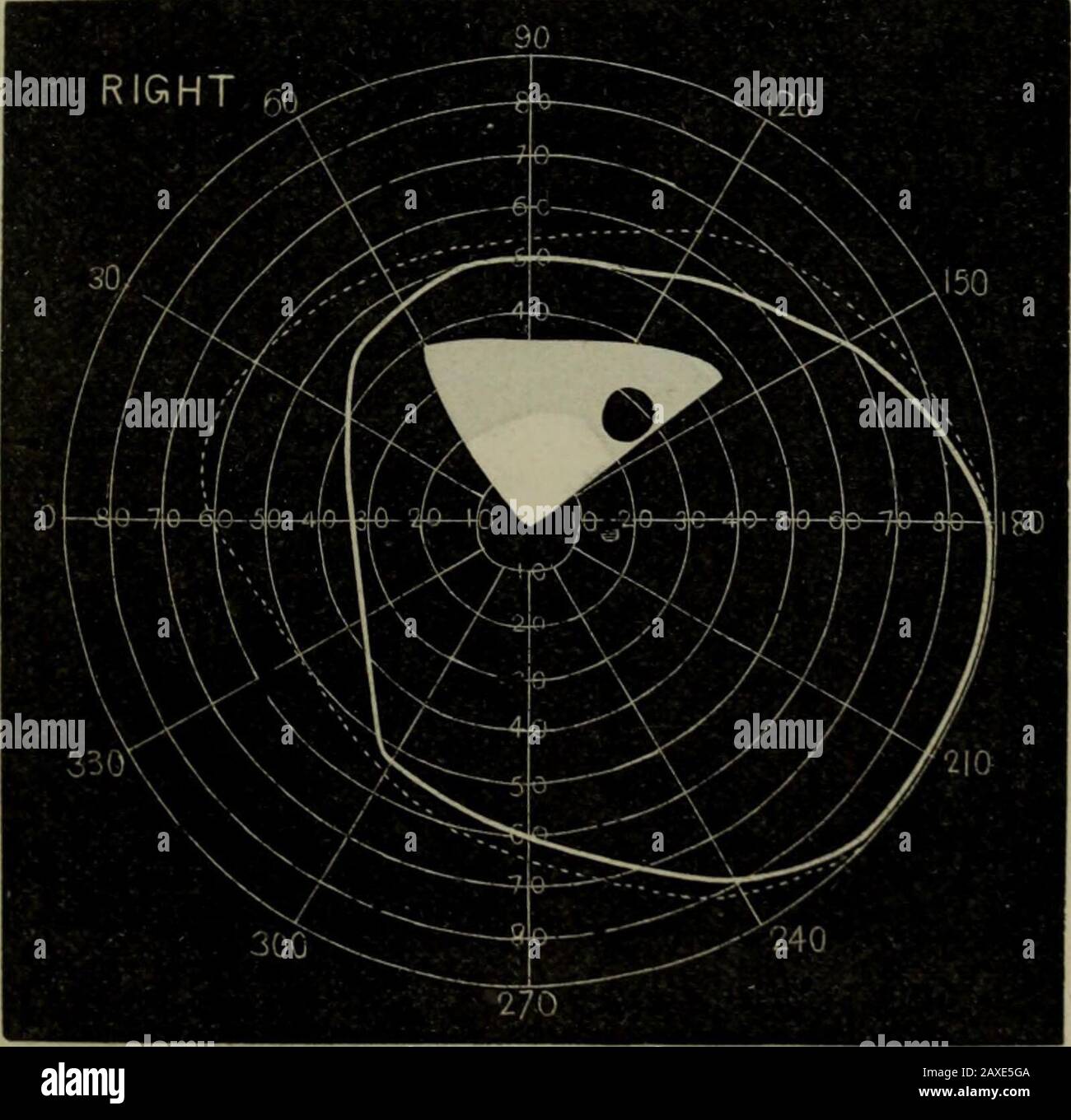 Transazioni . R, - Campo su marzo 7th.. B.-Field il 10th marzo. 154 MALATTIE DELLA RETINA. Foto Stock