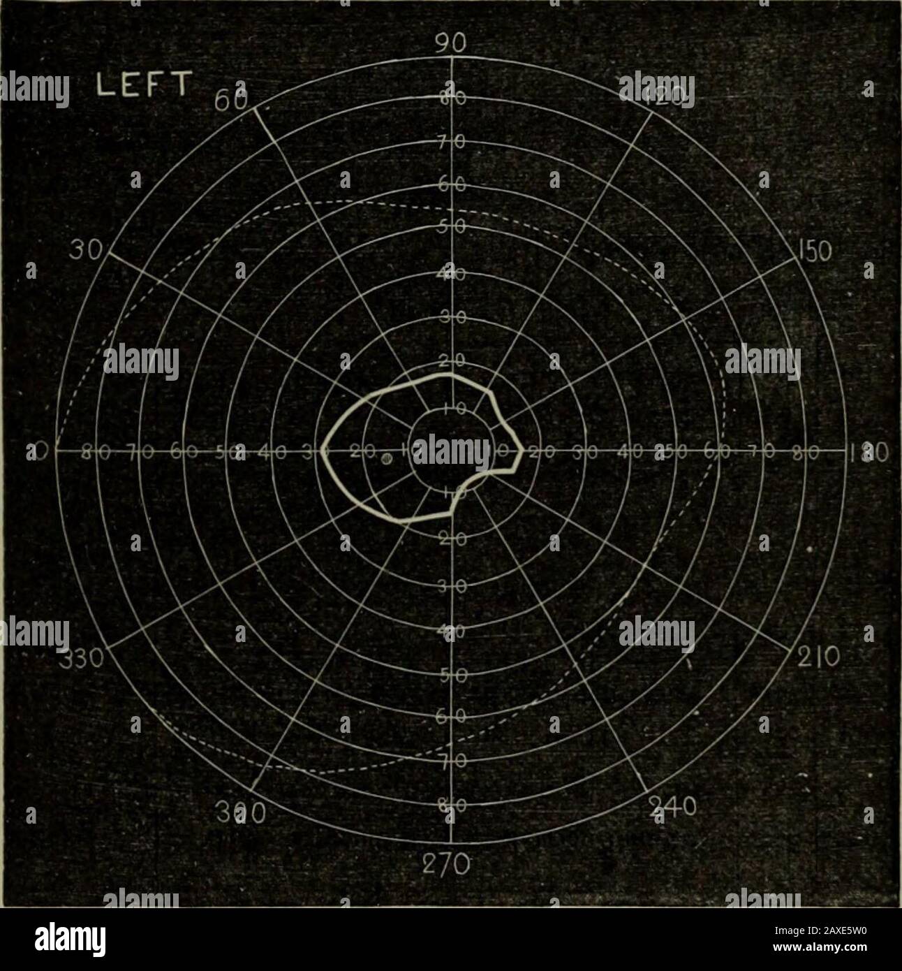 Operazioni . g e HNOg. L'ipogastrio è occupato da un tumore, ovoide, mesiale, la dimensione di un 6 mesi* presog-nancy ; è duro, noioso, muto ; senza dubbio un fibroide uterino.There è un soffio sistolico, basico, cardiaco. Sei mesi fa la vista dell'occhio sinistro cominciò a fallire, pensa improvvisamente; non si ricordava alcun traumatismo. Onexamination con il perimetro si trova che la visione iscentrale che è persa assolutamente, percep-tion periferico essendo presente ma carente. I media sono chiari ;T. n. Occupando il sito della fovea e un'area DI DISTACCO centrale EETINAL. 129 due volte la sua dimensione Foto Stock