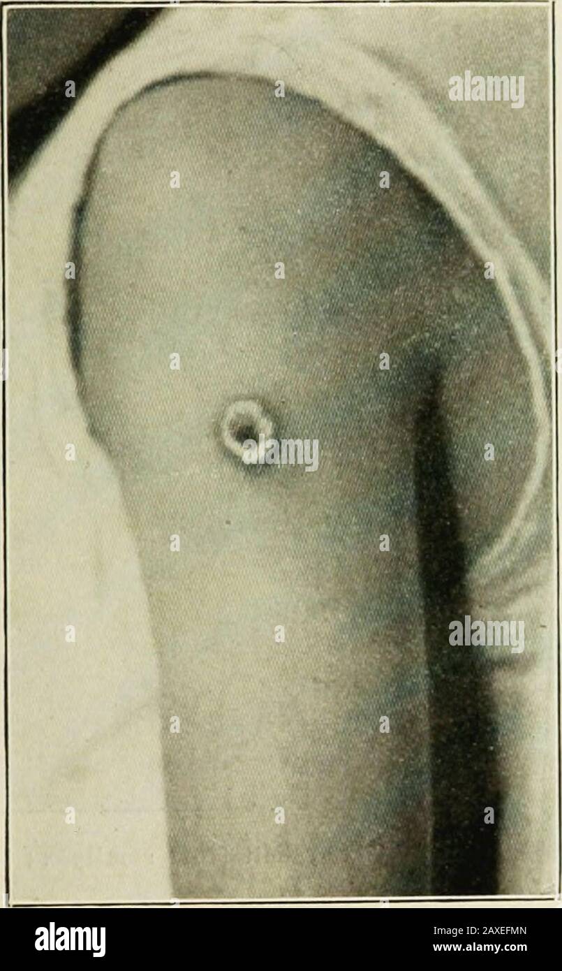 La vaccinazione e il suo rapporto con la sperimentazione animale . Fig. 4. – un aspetto normale il settimo giorno di vaccinazioneConfronta il quadro con quello dei piccoli. Sono stati vaccinati circa un terzo della popolazione. Se la vaccinazione non conferisce protezione contro il vaiolo, è ragionevole supporre che alcuni dei thesepersons avrebbero contratto la malattia e portato all'ospedale. (Circa così per cento, di tutti i thecases nella città sono stati inviati all'ospedale.) Ma il paziente notali potrebbe essere trovato fra oltre 3.500 admis-sions. 40 Al fine di fornire alloggi nel Municipio Hospit Foto Stock